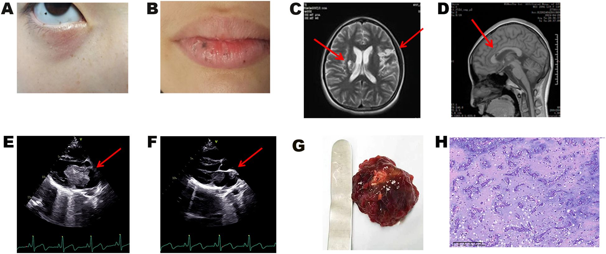 A shows a close-up of an eye with dark spots below. B is a close-up of lips with dark pigmentation. C is an MRI scan of the brain with two arrows pointing at highlighted areas. D is a side MRI view with an arrow pointing to a specific region. E and F are ultrasound images with red arrows indicating certain structures. G displays a dark, irregular mass next to a metal instrument. H shows a microscopic view of tissue with varying shades of purple and pink, depicting cellular structures.