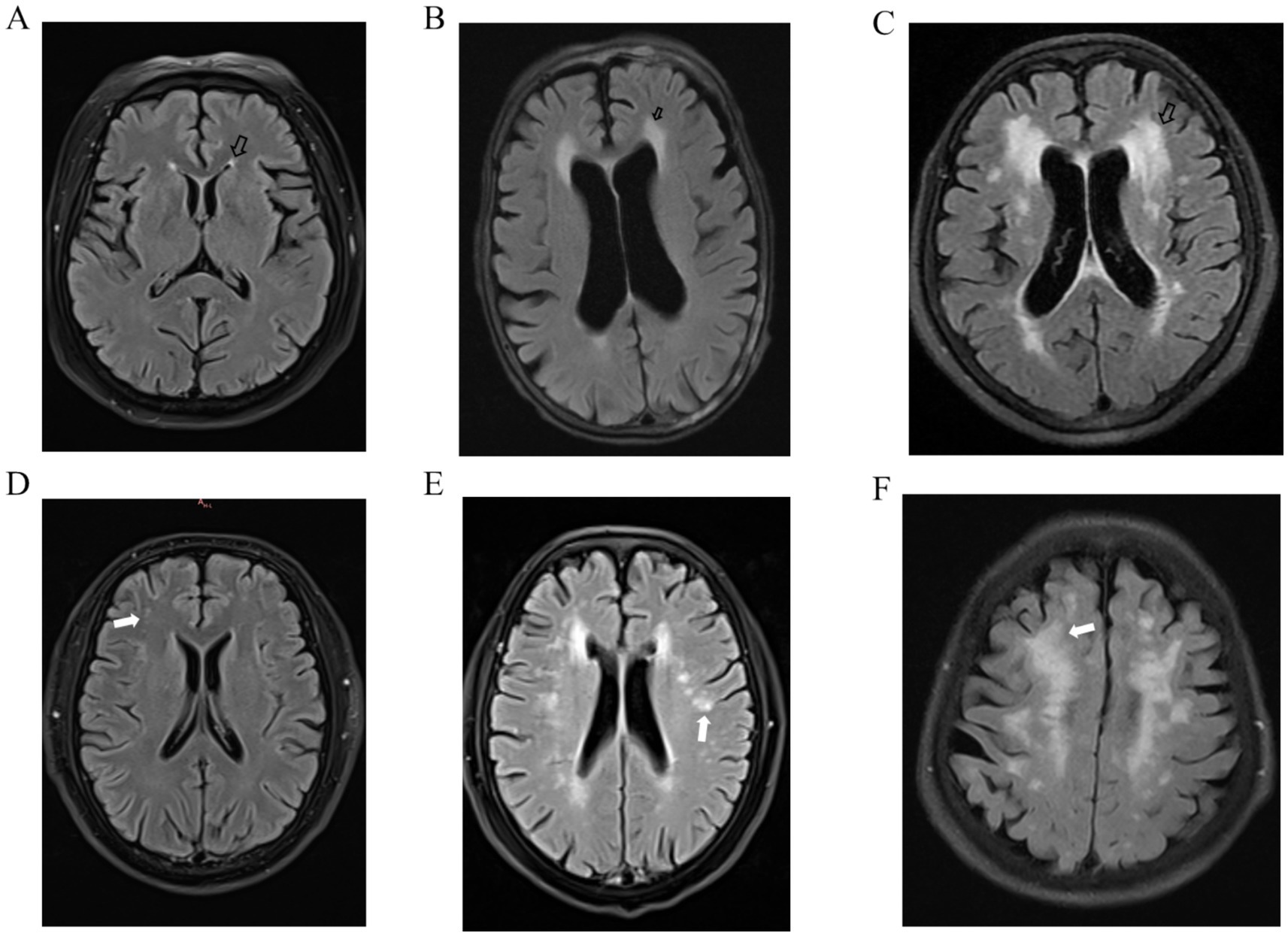 Six MRI brain scan slices labeled A to F show various brain structures. Black and white arrows highlight specific areas of interest, indicating differences in brain tissue possibly related to medical conditions. Each image shows subtle variations in brain anatomy and signal intensity.
