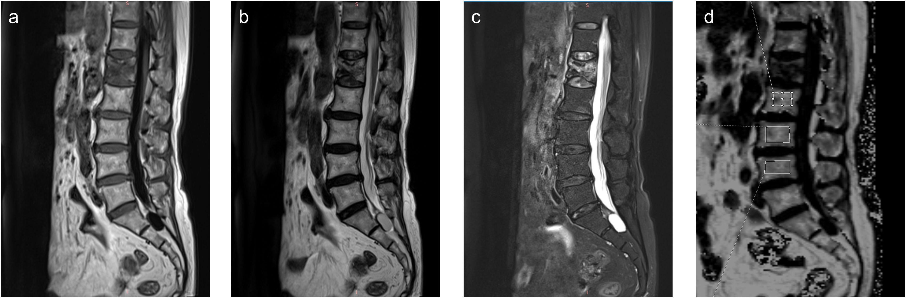 Four MRI scans labeled a, b, c, and d display transverse sections of the lumbar spine. Image a shows a regular view, b is similar but appears slightly enhanced, c includes prominent spinal fluid contrast, and d highlights specific vertebral regions with outlined areas.