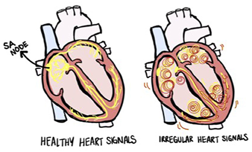 Illustration comparing healthy and irregular heart signals. The left heart shows smooth, coordinated yellow lines indicating normal electrical signals. The right heart shows chaotic, swirling lines representing irregular heart signals. Labels: SA Node, Healthy Heart Signals, Irregular Heart Signals.