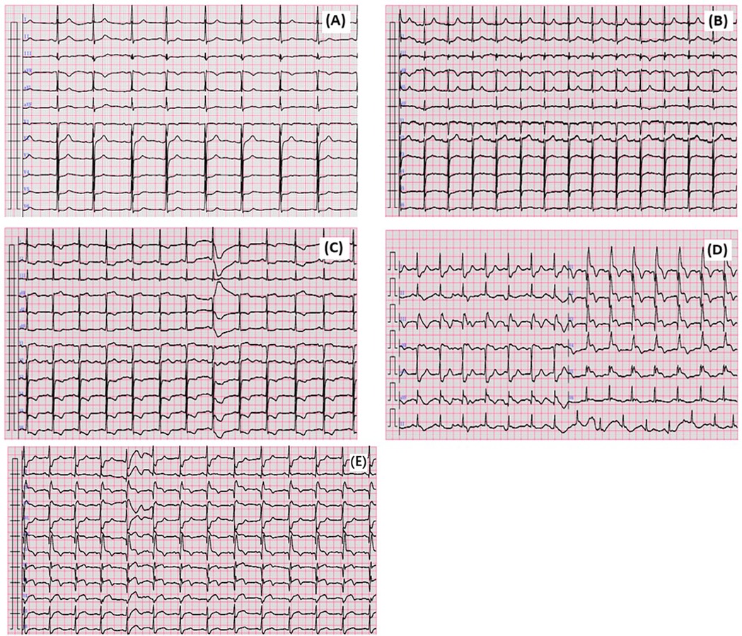 Five ECG tracings labeled A to E display various heart rhythms. Tracing A shows regular rhythm with prominent R waves. Tracing B depicts a similar pattern but with slightly higher amplitude. Tracing C appears irregular with noticeable variations. Tracing D has rapid, irregular waves, suggesting possible tachycardia. Tracing E exhibits regular rhythm with consistent waveforms. The tracings are on a pink and white grid background.