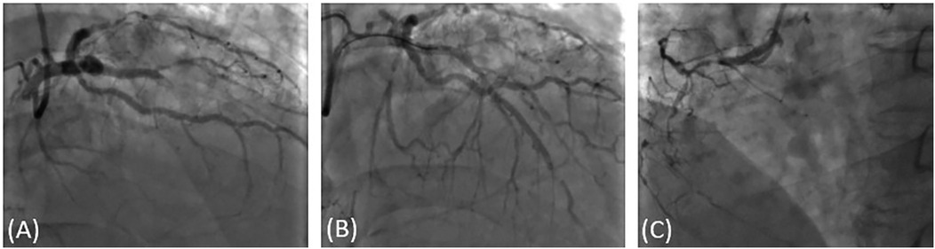 Three-panel angiogram images labeled A, B, and C, showing coronary arteries. Panel A displays an area with restricted blood flow. Panel B shows partially restored flow. Panel C depicts improved blood flow continuity in the arteries.