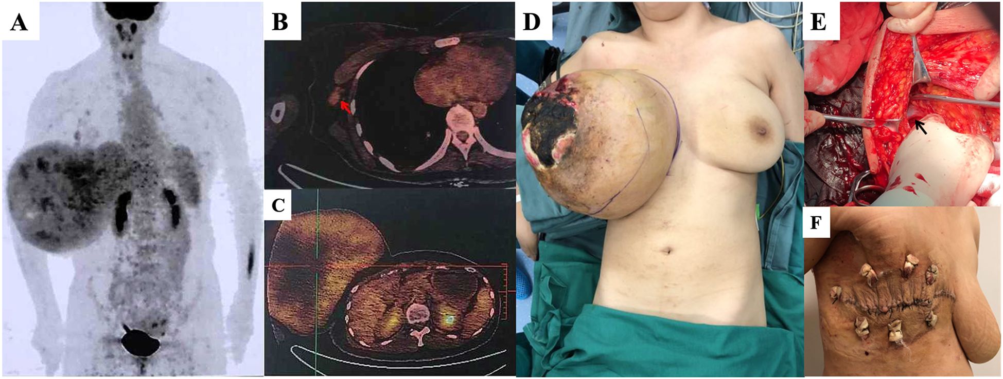 Six-panel medical image series. Panel A shows a scan highlighting a large mass in the torso. Panels B and C show tomography scans with an indicated tumor. Panel D depicts a patient with a large visible tumor. Panel E shows a surgical procedure involving tumor removal. Panel F displays the post-operative scar with stitches on the patient's back.