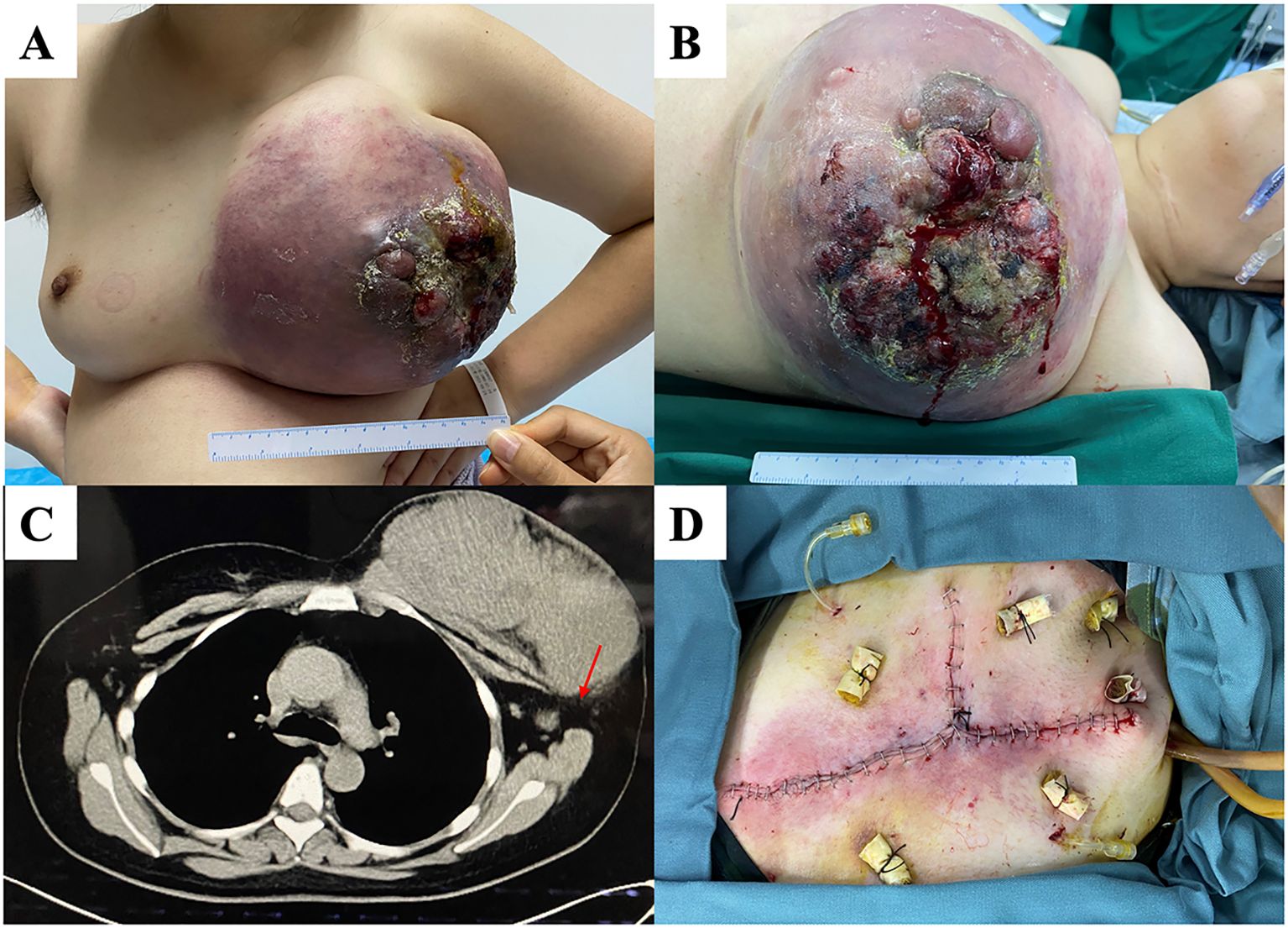 A series of four images depicting a medical case. Image A shows a large, swollen mass on the right chest of a person, with visible skin discoloration and ulceration. Image B provides a closer view of the ulcerated mass with areas of exposed tissue and bleeding. Image C is a CT scan showing the mass in the chest region, indicated by a red arrow. Image D displays the post-surgical site on the chest, with sutures and drainage tubes in place.