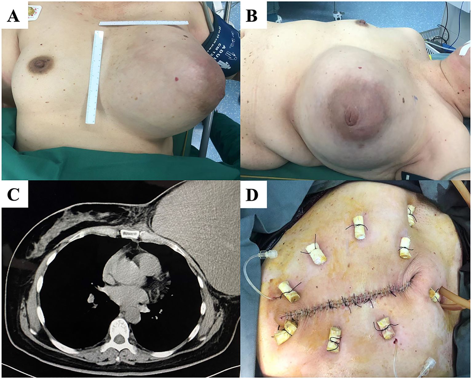 Image showing four panels labeled A to D. Panel A displays a close-up of a person's chest with measuring rulers placed across a large swelling. Panel B shows a similar view from the side. Panel C contains a black and white CT scan of the chest area showing internal structures. Panel D depicts a surgical site on a chest, with stitches and drainage tubes in place.