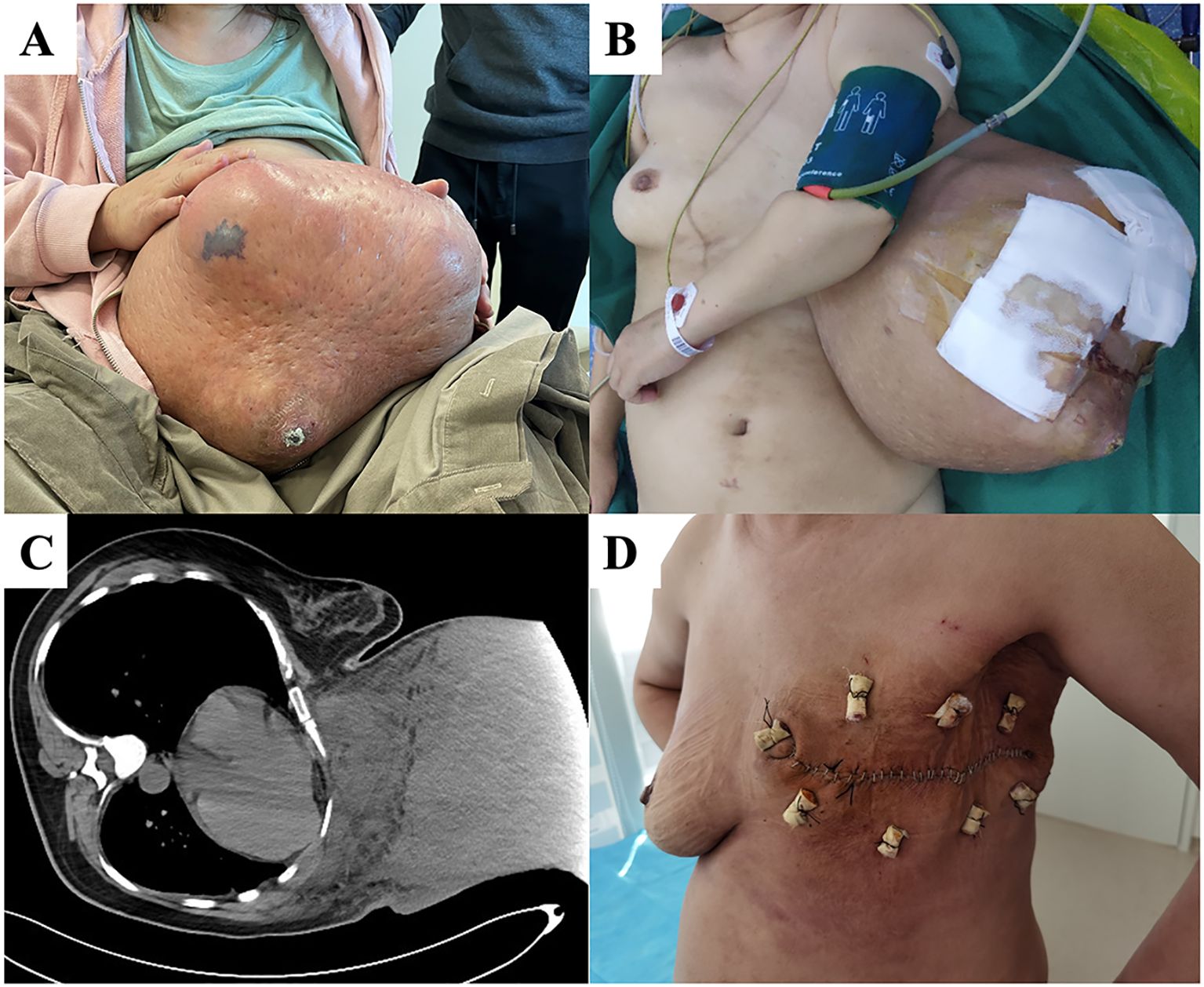 A series of four medical images depicting a large thoracoabdominal mass. A shows the mass on a seated person pre-operatively. B displays the mass post-operatively with dressings. C is a CT scan showing the mass’s structure. D shows the person post-surgery with a stitched wound and drainage tubes.