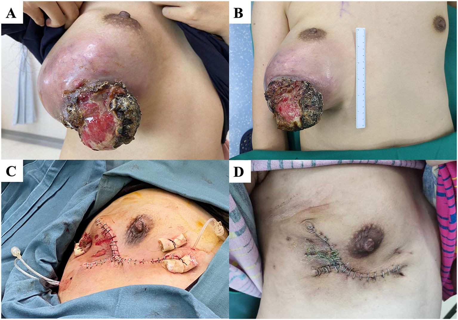 A four-part medical image series shows a large breast tumor before and after surgical removal. Panel A and B depict the tumor with necrotic tissue and a scale for reference. Panel C shows the surgical site post-tumor removal with stitches and drainage tubes. Panel D displays the healed surgical site with staples and reduced scarring.