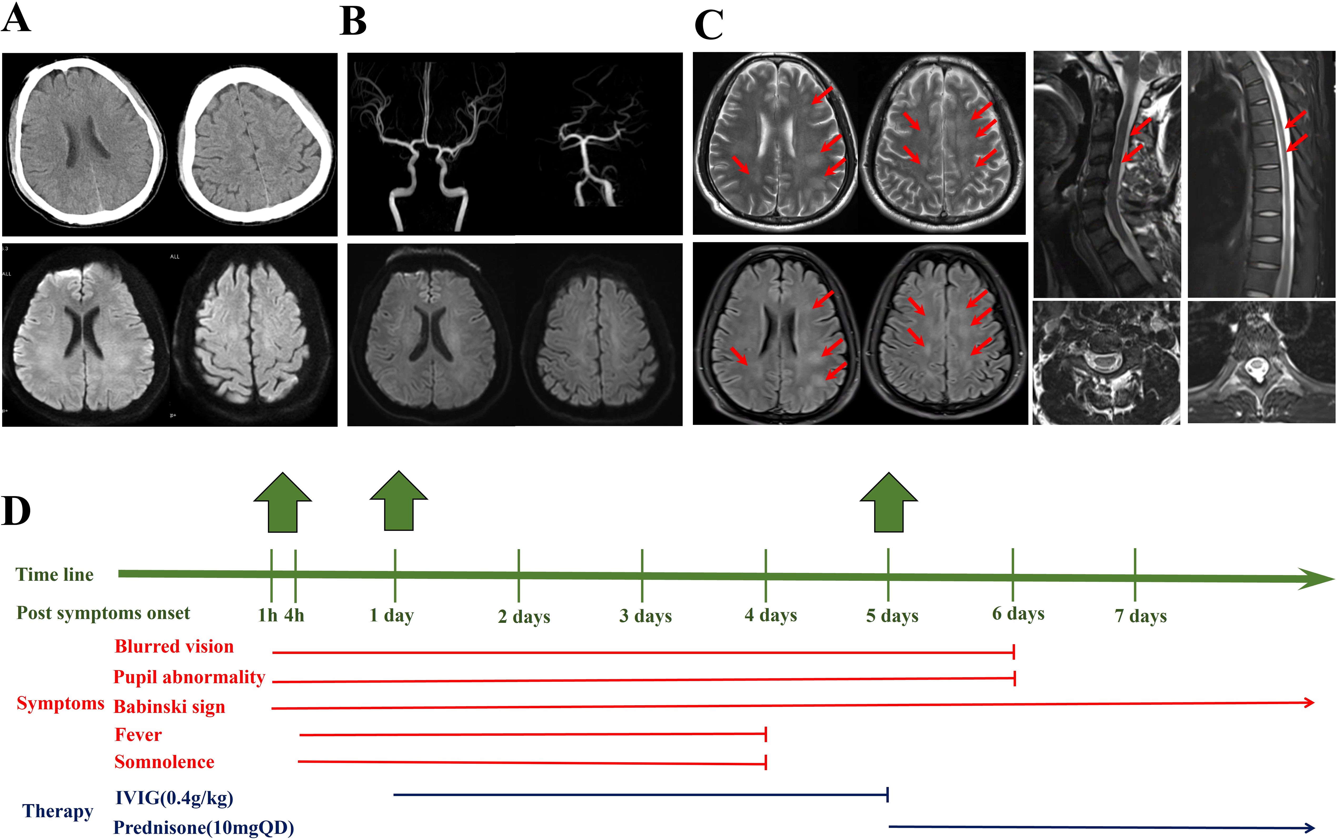 Four panels labeled A to D. Panel A: brain scans showing normal brain structure. Panel B: angiography images of brain blood vessels. Panel C: brain and spinal cord MRIs with red arrows indicating abnormalities. Panel D: a timeline chart showing the onset and duration of symptoms like blurred vision, pupil abnormality, and fever, alongside therapies such as IVIG and Prednisone.