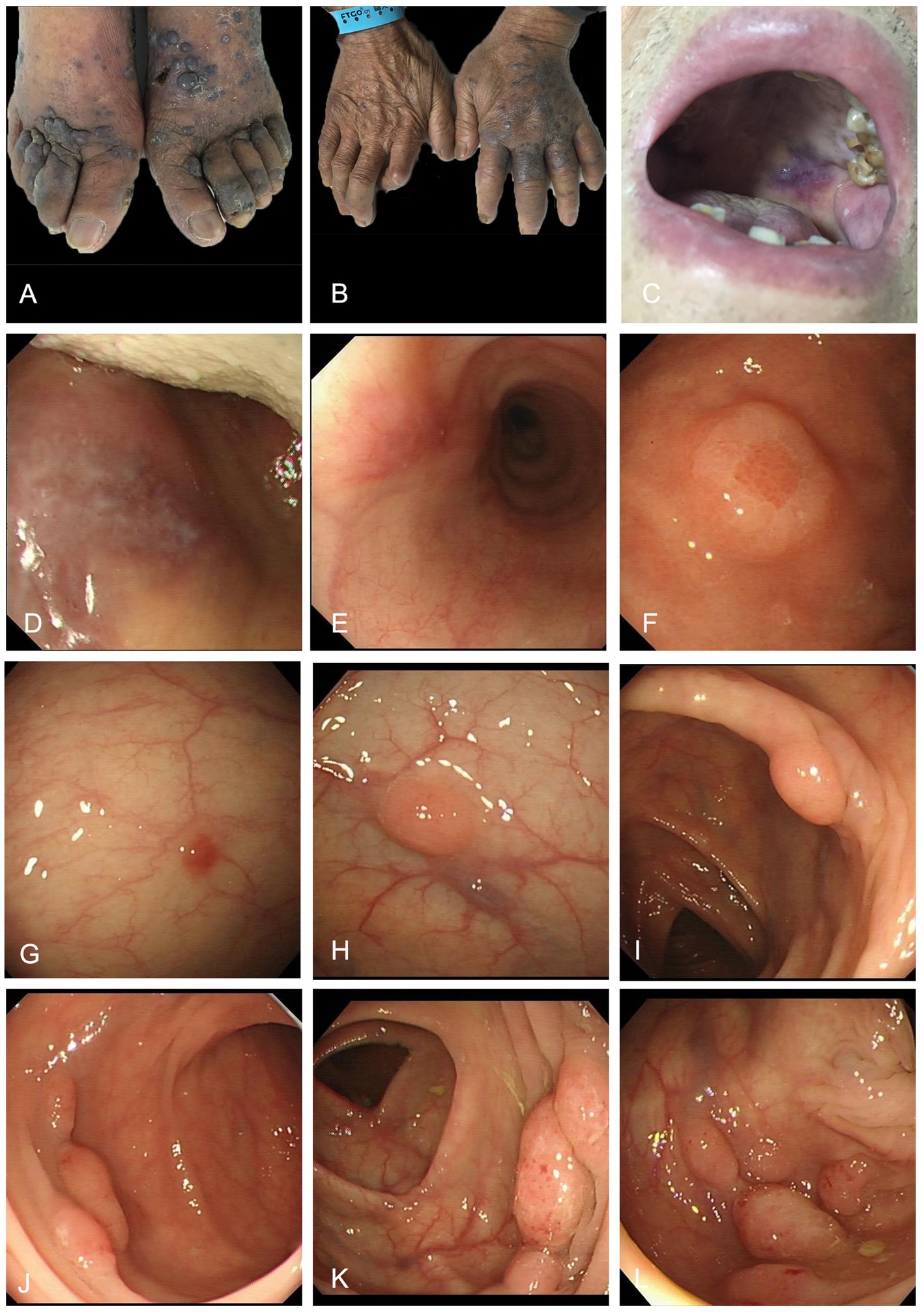 Grouped medical images showing various conditions:A) Discolored feet with lesions. B) Hands with similar skin lesions. C) Open mouth displaying oral lesions. D) Close-up of internal lesion. E) Esophageal view. F) Circular internal lesion. G) Small internal spot. H) Raised round internal lesion. I) Intestinal view with polyps. J) Internal intestinal view. K) Multiple intestinal lesions. L) Clustered intestinal lesions.