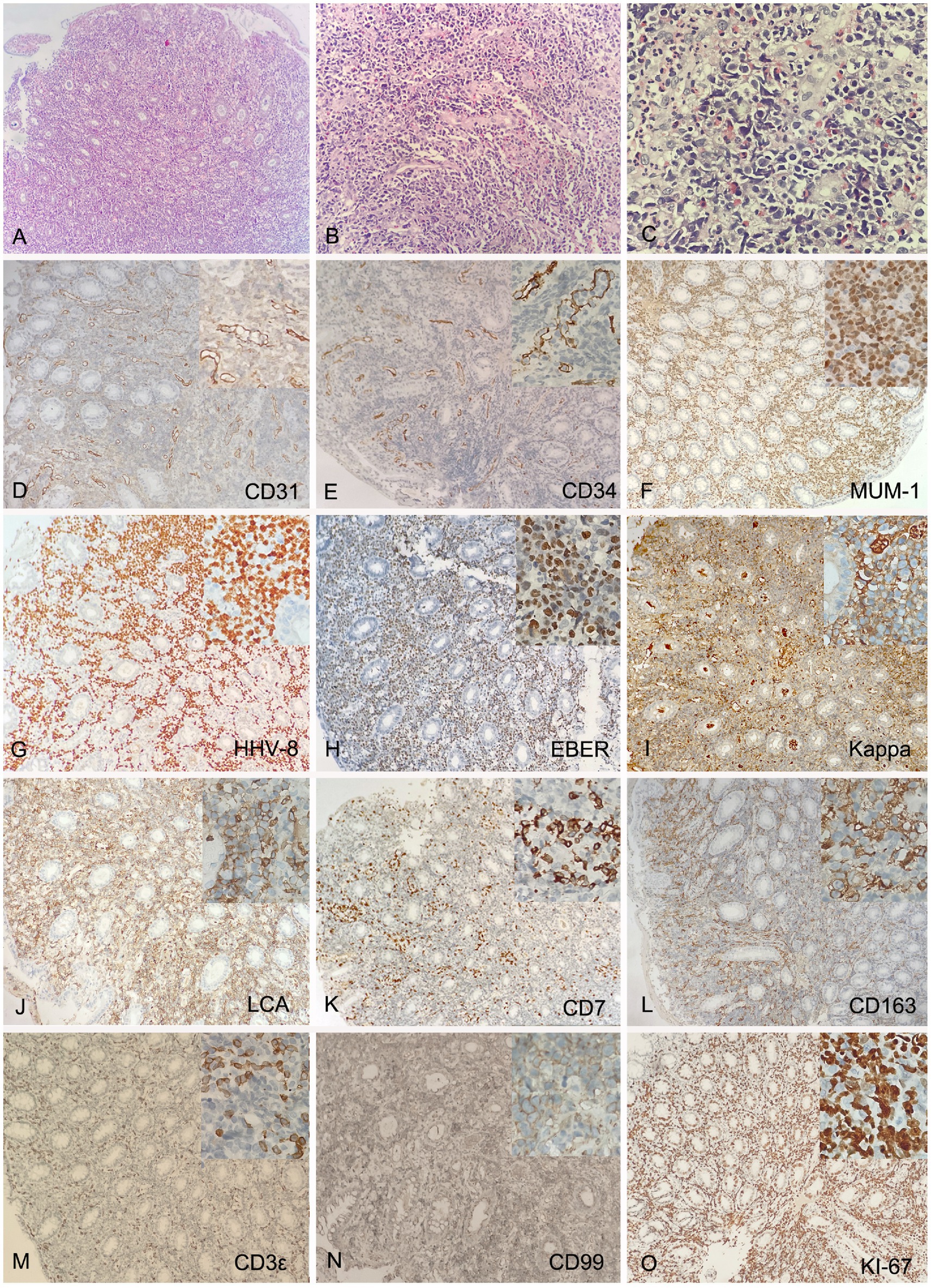 Histopathological examination showing a series of stained tissue samples labeled A to O. Various immunohistochemical markers like CD31, CD34, MUM-1, and others are used to highlight cellular components. Insets provide close-up views of specific cell structures. Each panel demonstrates a different staining pattern or intensity, indicative of diverse tissue characteristics and diagnostic markers.