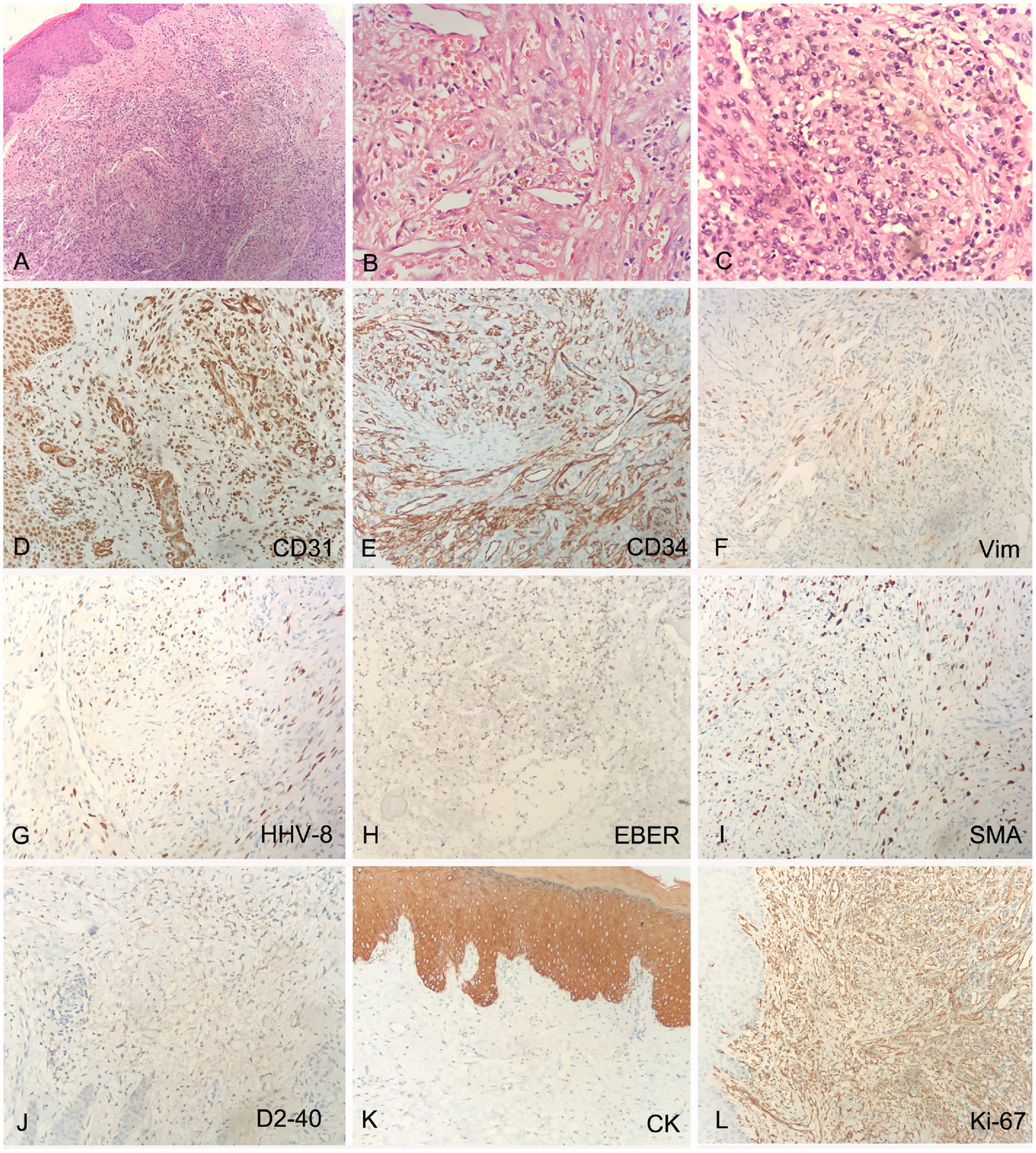 Histological panel showing twelve images with various staining and markers. Panel A to C show tissue samples with different histological features. Panels D to L are labeled with markers: CD31, CD34, Vim, HHV-8, EBER, SMA, D2-40, CK, and Ki-67, indicating immunohistochemical staining results for each. The staining highlights specific cellular and tissue structures, aiding in diagnosis and analysis.