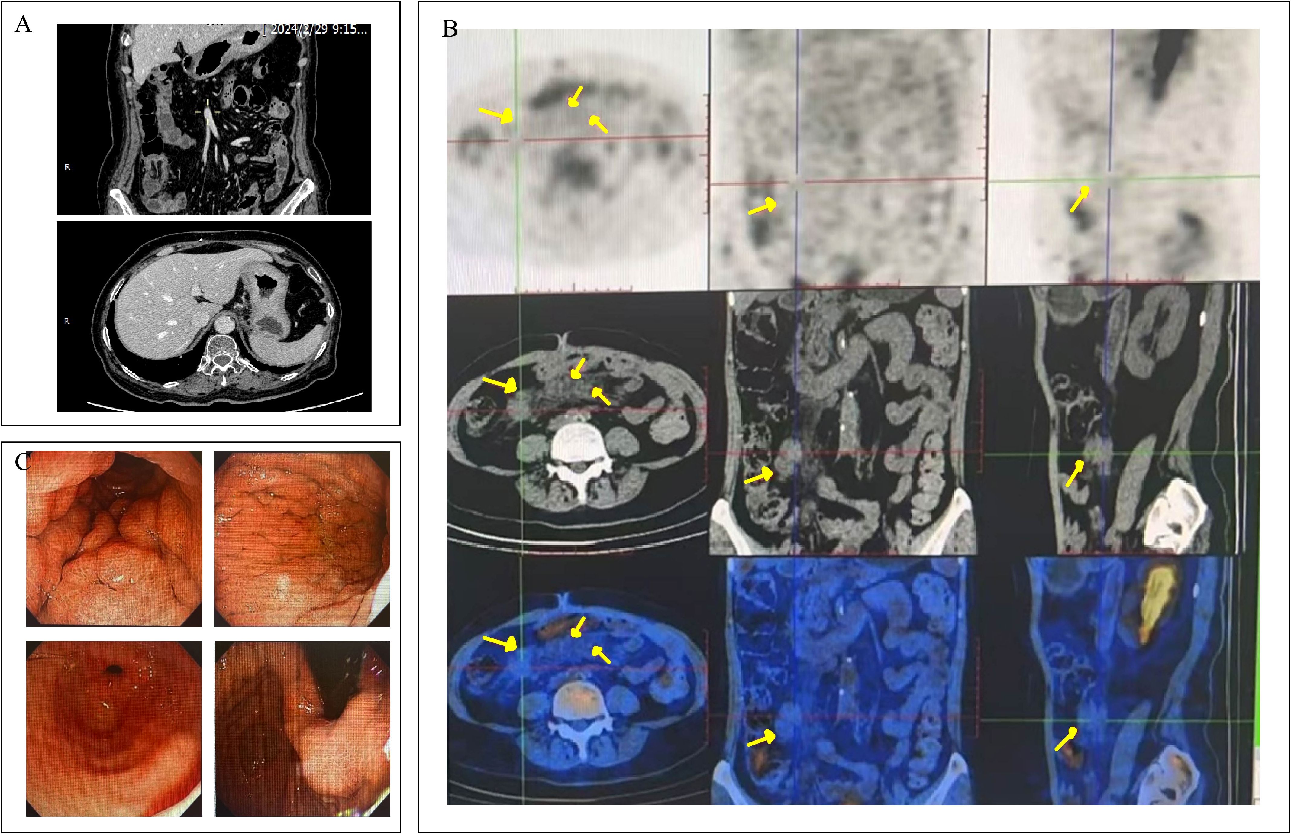 A composite image featuring diagnostic scans and images: Section A shows two CT scans with frontal and cross-sectional views of the abdomen. Section B presents multiple PET and CT scan images with yellow arrows indicating specific areas. Section C displays four endoscopic images of the interior of the gastrointestinal tract.