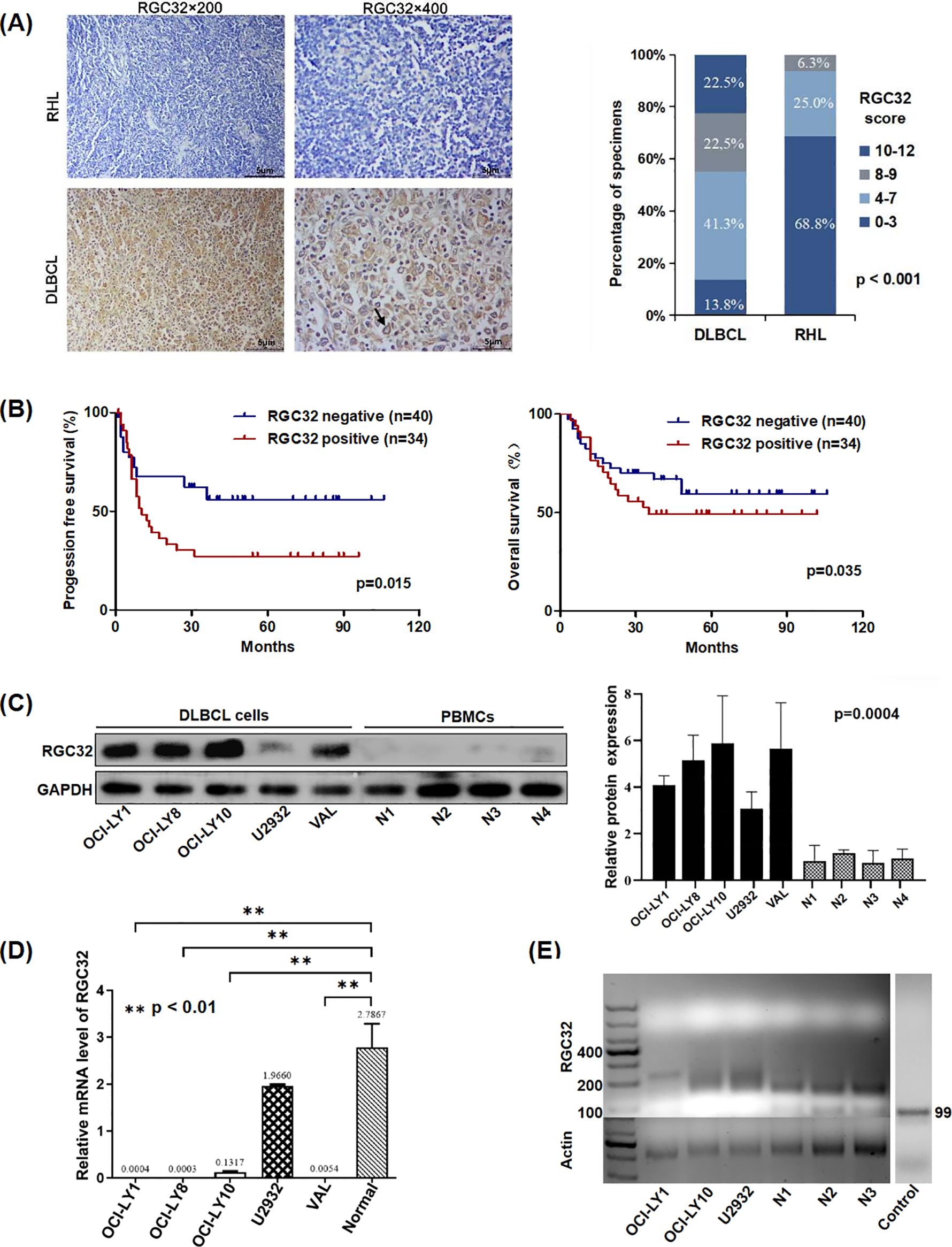 Panel (A) shows RGC32 stained tissue sections with different magnifications for RHL and DLBCL, alongside a bar chart of RGC32 score distribution. Panel (B) includes Kaplan-Meier curves highlighting progression-free and overall survival for RGC32 positive and negative groups, with significant p-values. Panel (C) displays a Western blot for RGC32 protein expression in DLBCL cells and PBMCs, accompanied by a bar graph of expression levels. Panel (D) presents a bar graph comparing relative mRNA levels of RGC32 across different cell lines. Panel (E) features a gel electrophoresis image depicting RGC32 and actin bands for various samples.
