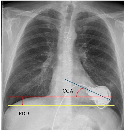 Chest X-ray showing a device implanted at the cardiac appex. Red and yellow lines indicate measurement labeled CCA (cannula coronar angle) and PDD (pump diaphragm deapth).