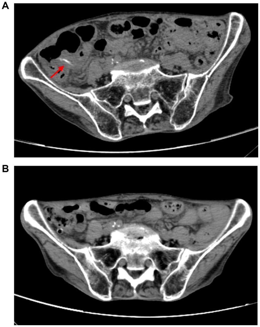 CT images labeled A and B show axial views of the pelvis. Image A highlights a region with a red arrow, indicating a specific area of interest in the pelvic region. Both images reveal pelvic structures and tissues in cross-section.