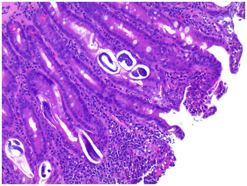 Microscopic view of human intestinal tissue stained with hematoxylin and eosin, showing elongated, purple-stained nuclei of epithelial cells. Pink cytoplasm and glandular structures are visible.