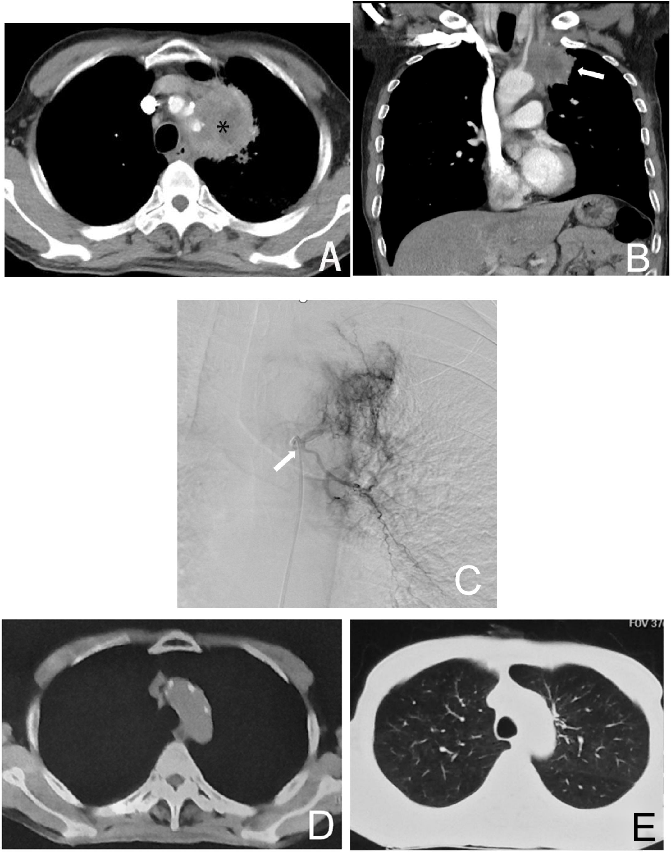 CT scans and an angiography of the chest are displayed. Image A shows a large mass in the mediastinum. Image B highlights a different angle, with a noticeable arrow indicating a specific area. Image C presents an angiographic view of vessel irregularities marked by an arrow. Image D is a CT scan post-treatment, showing the resolved mass. Image E reveals a standard lung view, indicating normal lung anatomy after treatment.