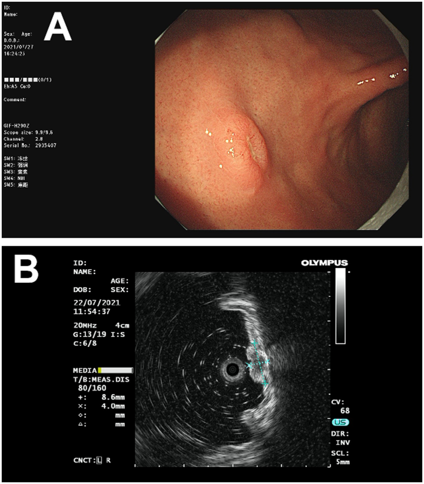 Panel A shows an endoscopic image of the esophagus with inflamed tissue. Panel B presents an ultrasound image, featuring a circular structure at the center with surrounding tissue details. Both images are labeled with technical details.