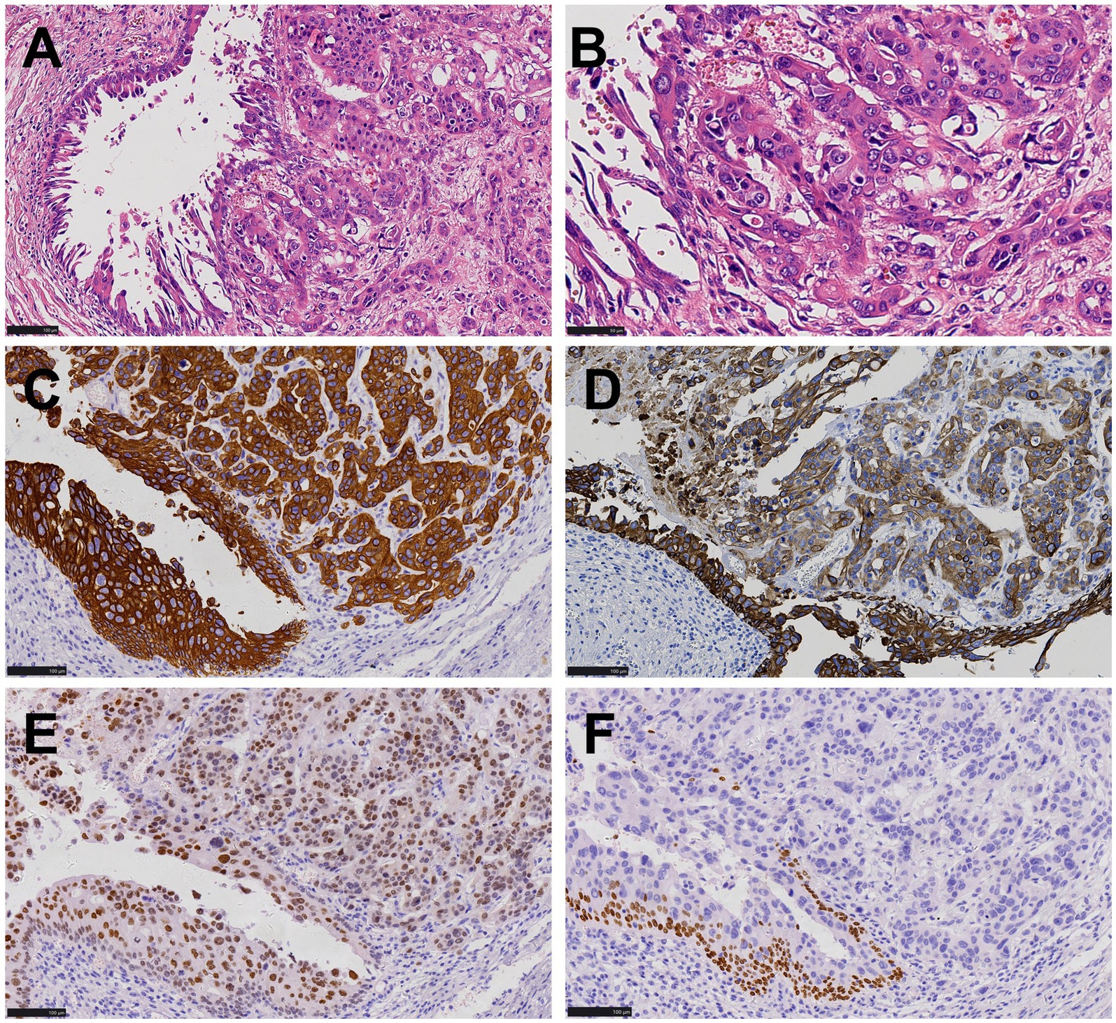 Histological slide images A to F show tissue samples stained to highlight cellular structures. Panels A and B display pink and purple-stained cells, indicating hematoxylin and eosin staining. Panels C to F show brown-stained areas against a blue background, indicating different levels and patterns of immunohistochemical staining. Black scale bars present in each image suggest measurement references.