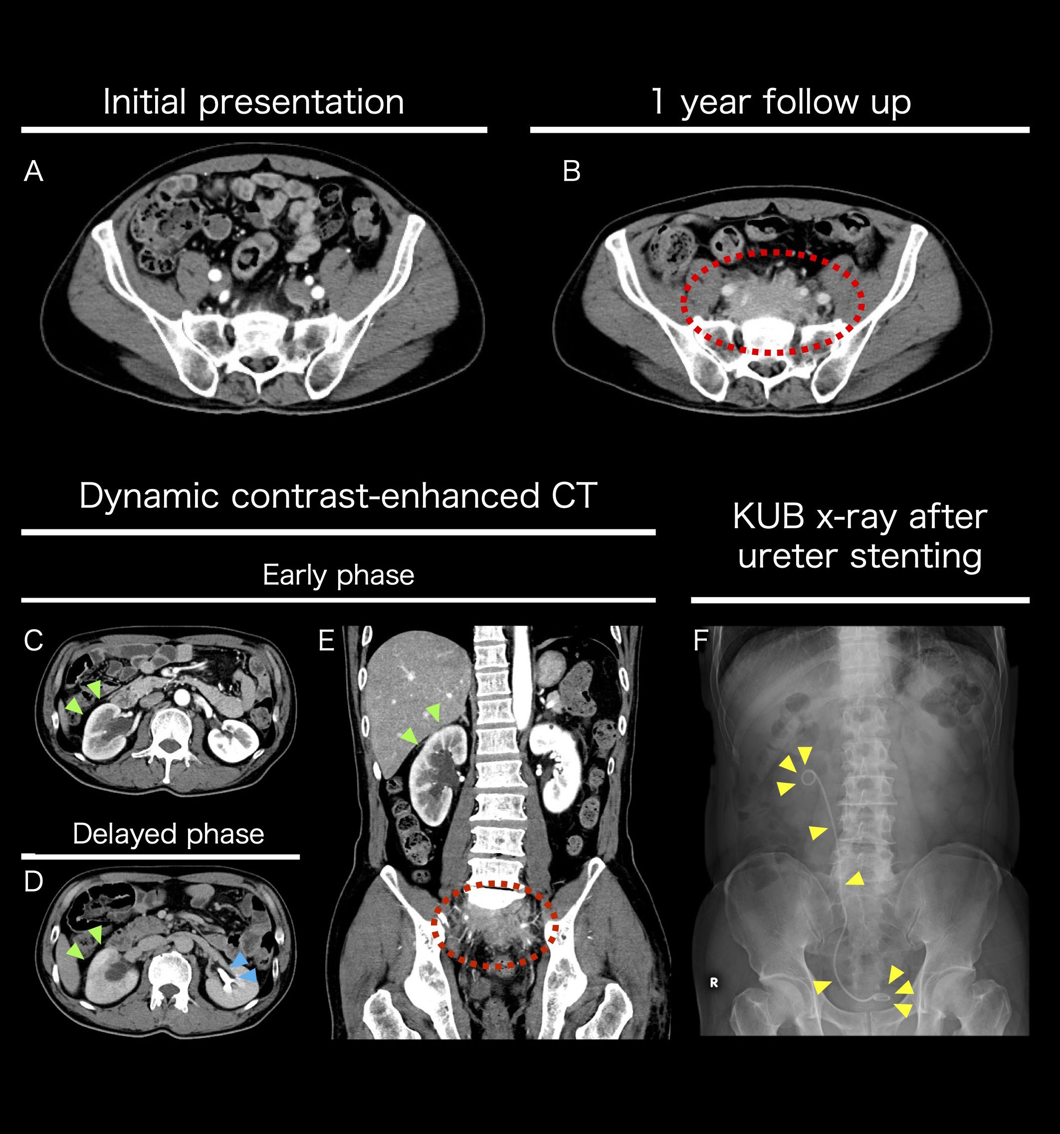 CT and X-ray images showing abdominal scans at different stages and conditions. Panel A shows an initial presentation CT scan. Panel B illustrates a one-year follow-up CT, with an area highlighted in red. Panels C and D depict early and delayed phases of a dynamic contrast-enhanced CT scan, respectively, with areas marked by green and blue arrows. Panel E is a coronal view in the same dynamic phase, highlighting another area in red. Panel F presents a KUB X-ray after ureter stenting, with the stent indicated by yellow triangles.