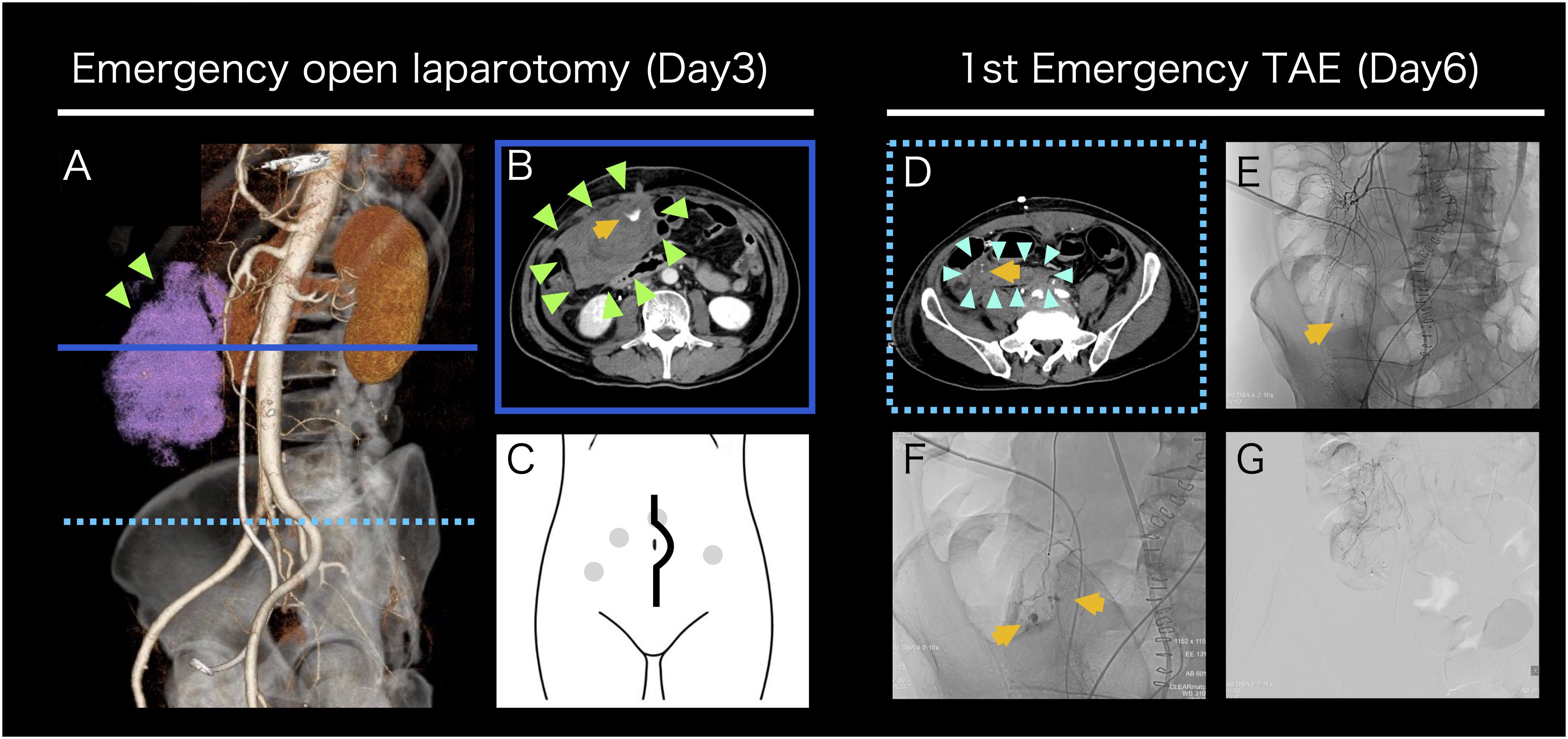 Medical imaging comparison showing two procedures. On the left, images A, B, and C depict an emergency open laparotomy on day three, highlighting areas with colored markers indicating specific regions of interest. On the right, images D, E, F, and G show the first emergency transarterial embolization (TAE) on day six, with similar markers highlighting different areas. Diagrams and X-ray overlays are used to emphasize the surgical and anatomical details.