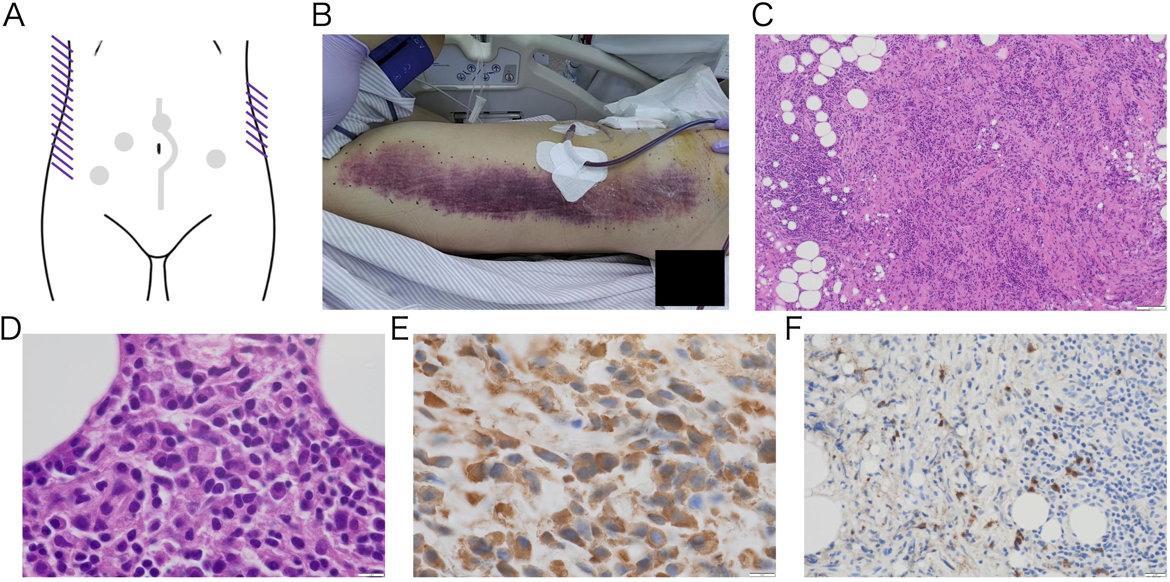 A multi-panel image showing the following: Panel A illustrates a medical diagram of a human torso with marks indicating procedural sites. Panel B is a photograph of subcutaneous hemorrhage on the right trunk with medical dressings and tubing. Panel C displays a microscopic view of tissue stained in purple and pink. Panel D shows a closer microscopic view of cells stained in purple. Panel E is another microscopic image with cells stained brown. Panel F shows a microscopic view with cells stained blue and brown. Each panel highlights different aspects of a medical scenario or procedure.