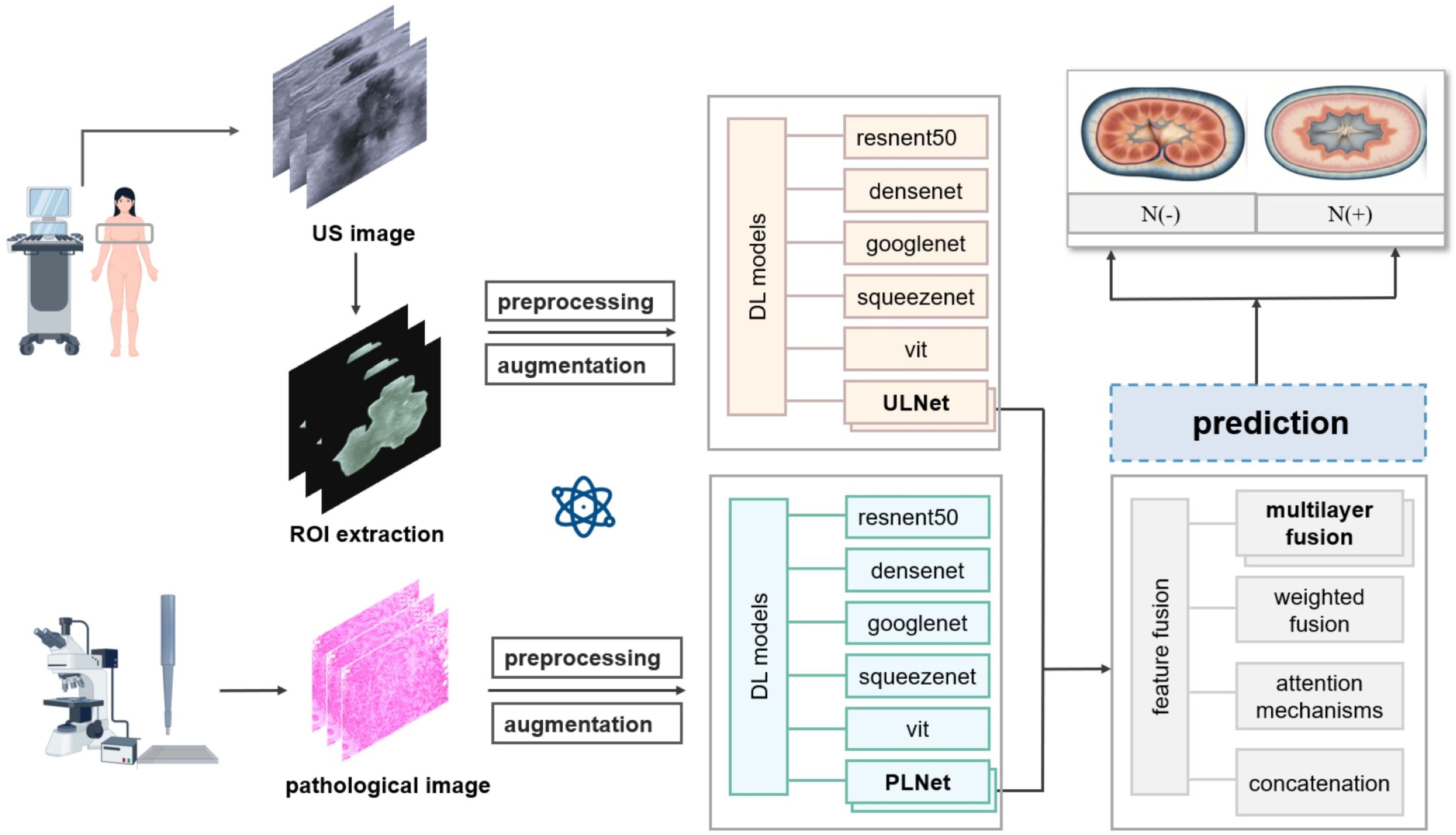 Flowchart depicting a medical imaging and analysis process. It starts with ultrasound and biopsy images undergoing preprocessing and augmentation. Separate deep learning models (ResNet50, DenseNet, GoogLeNet, SqueezeNet, ViT) are utilized within two networks: ULNet for ultrasound images and PLNet for biopsy images. Feature fusion techniques include multilayer fusion, weighted fusion, attention mechanisms, and concatenation. The final prediction differentiates between two outcomes indicated as N(-) and N(+).