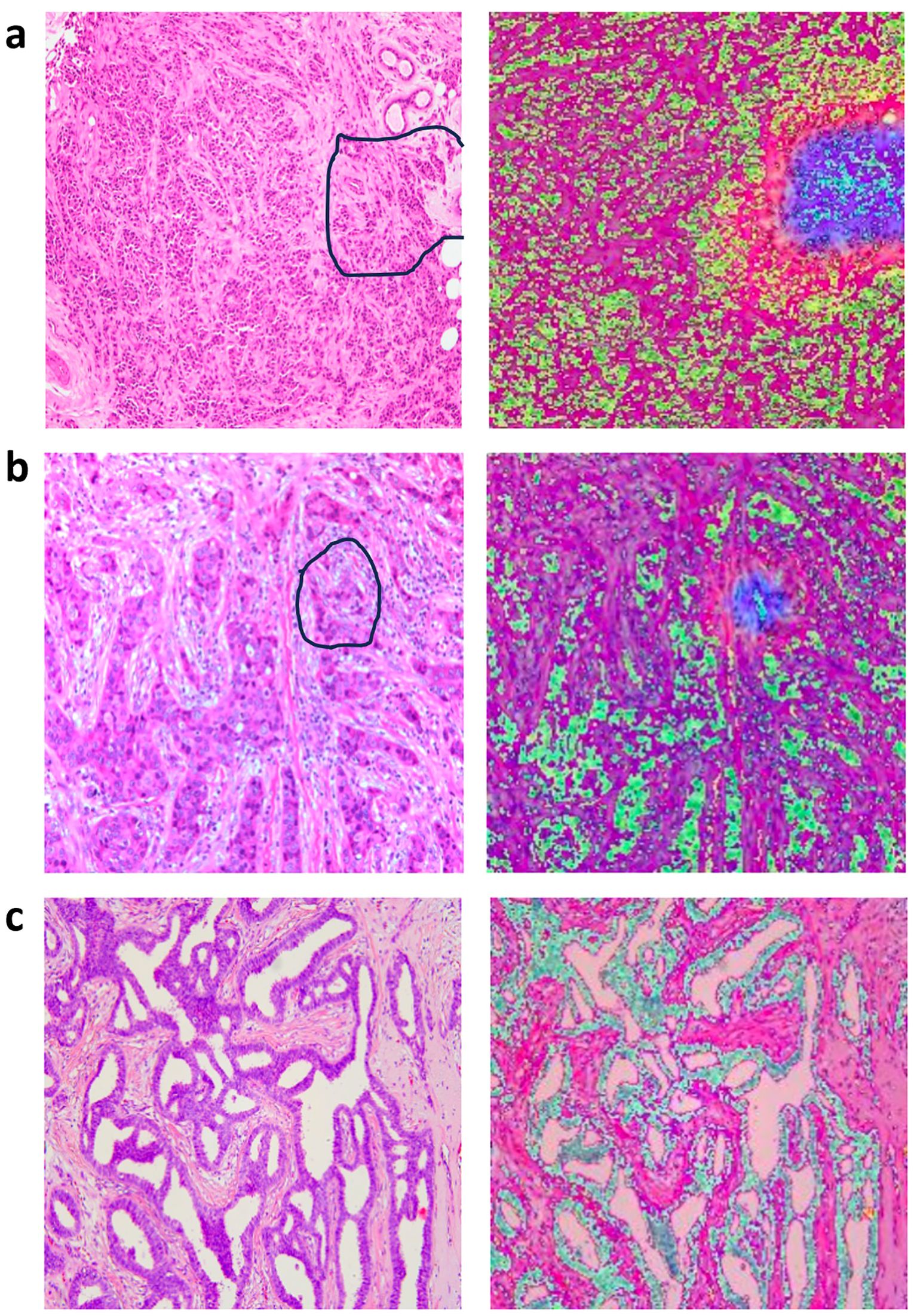 Representative histopathological images (left column) and corresponding attention heatmaps (right column) from three primary breast cancer patients. Panel a to b show images from two breast cancer patients with axillary lymph node metastasis, Panel c show images from one breast cancer patient without axillary lymph node metastasis. In the heatmaps, darker colors indicate regions with higher predictive value for axillary lymph node metastasis.