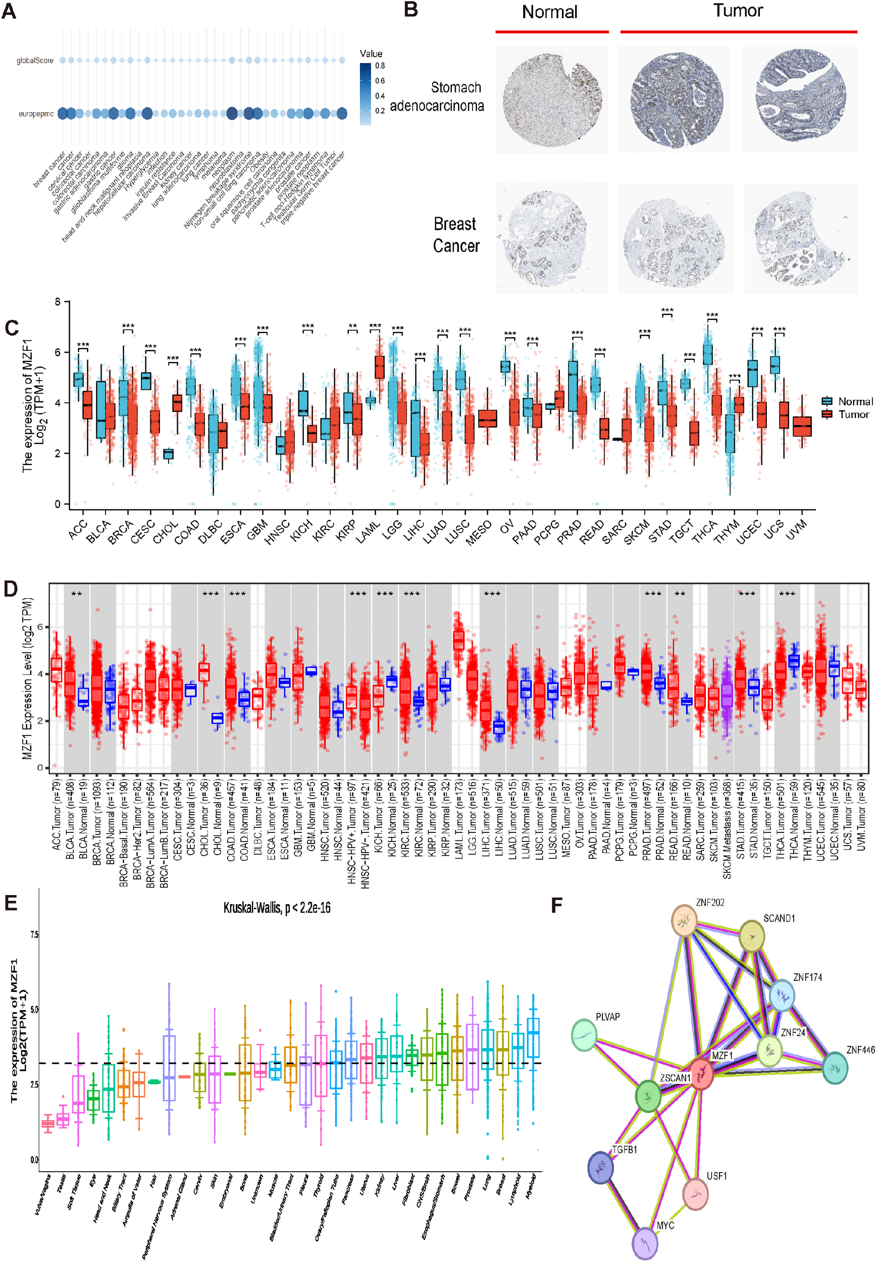 Panel A shows a bubble chart displaying expression values across different conditions. Panel B contains microscope images comparing normal and tumor tissues in stomach adenocarcinoma and breast cancer. Panel C and Panel D are box plots depicting the expression levels of specific genes across various cancer types, with significant differences noted. Panel E presents a box plot of MZF1 expression across different conditions, analyzed by Kruskal-Wallis test. Panel F is a network diagram illustrating the interactions among MZF1 and related proteins, showing various connection strengths.