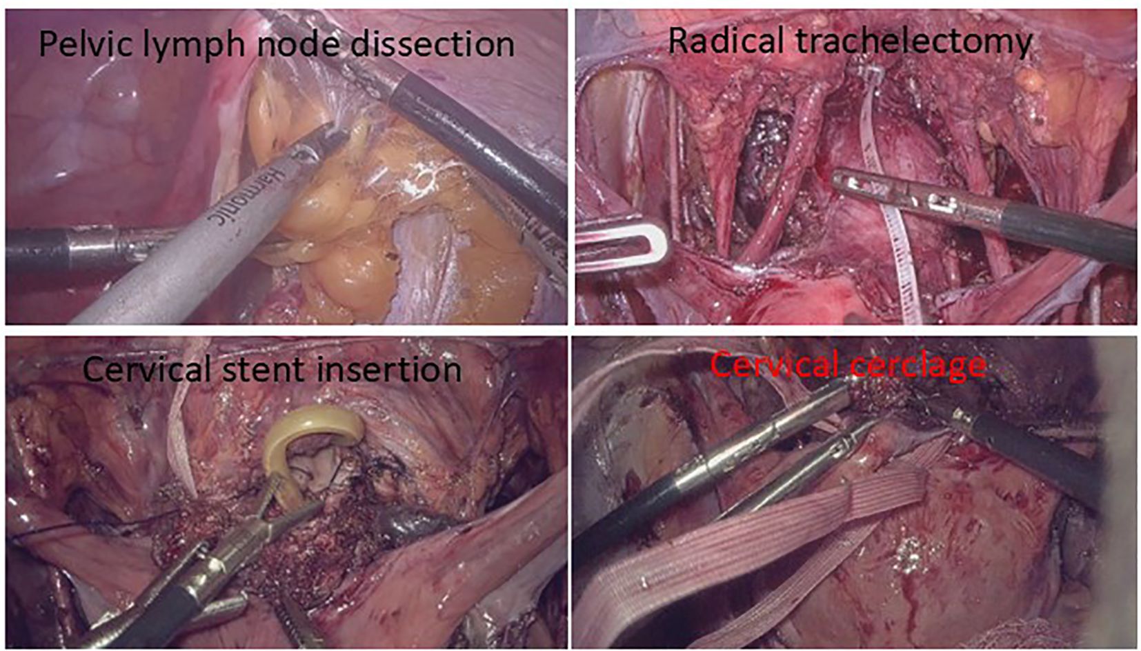 Four images showing surgical procedures. Top left: Pelvic lymph node dissection with instruments around yellow tissue. Top right: Radical trachelectomy with exposed tissue and measuring tape. Bottom left: Cervical stent insertion with a loop and instruments. Bottom right: Cervical cerclage with sutures and instruments.