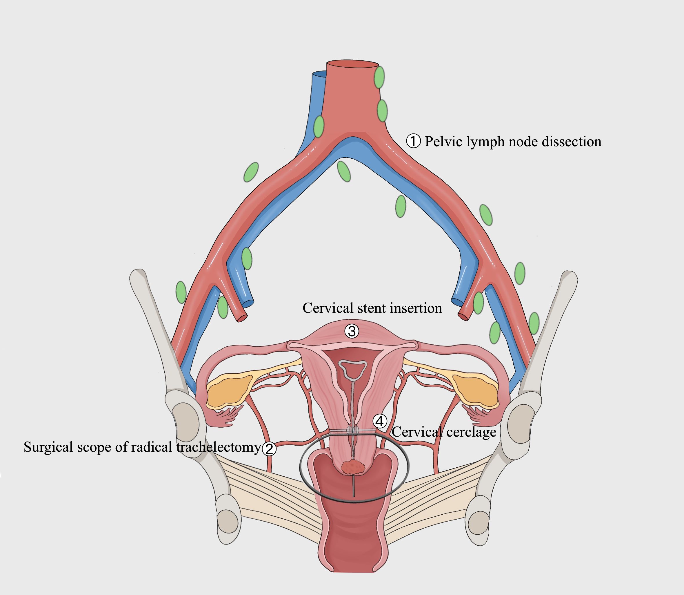 Diagram illustrating a radical trachelectomy procedure. It shows pelvic lymph node dissection, surgical scope of radical trachelectomy, cervical stent insertion, and cervical cerclage. Lymph nodes are depicted in green, blood vessels in red and blue, with anatomical labels for clarity.