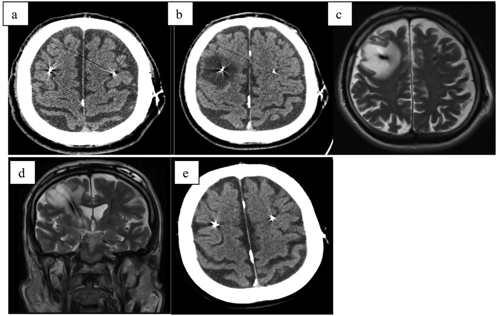 Five-panel medical imaging comparison. Panel a: Axial CT scan showing mild diffuse cerebral atrophy. Panel b: Axial CT with increased atrophy. Panel c: Axial MRI showing a prominent lesion in the right cerebral hemisphere. Panel d: Coronal MRI displaying bilateral atrophy. Panel e: Follow-up CT scan with further atrophy progression.