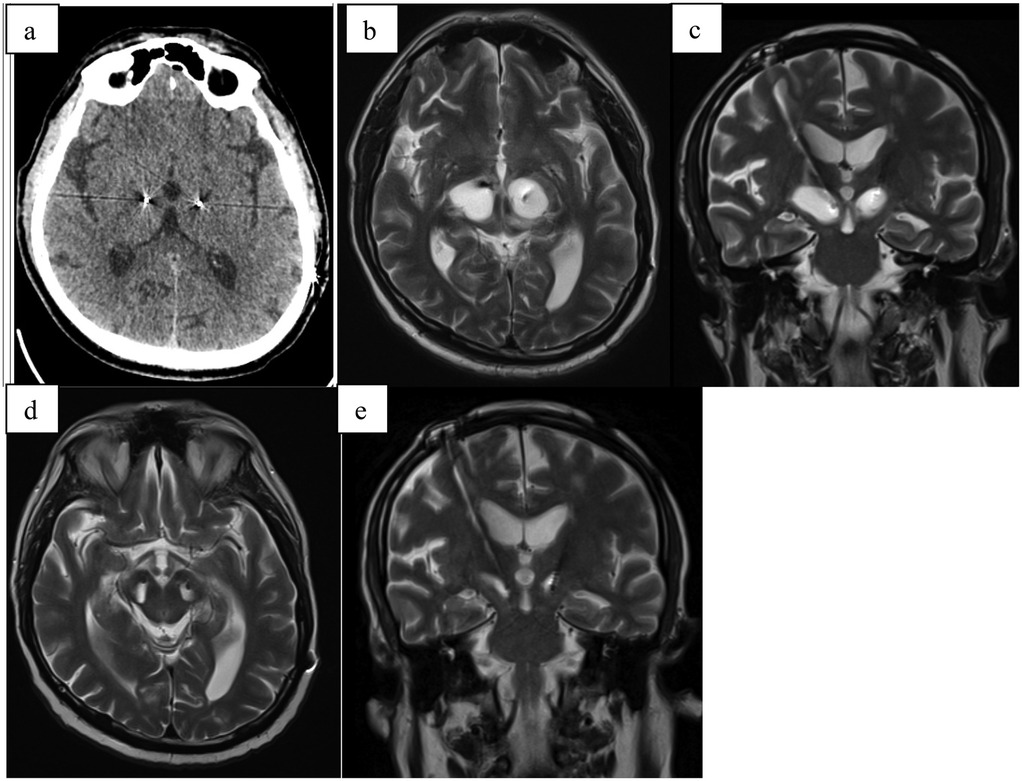 Five-panel image of brain scans. Panel (a) shows a CT scan with visible structural details. Panels (b), (d), and (e) display axial MRI images highlighting different brain regions. Panel (c) shows a coronal MRI image with clear contrast of brain structures. Each scan provides a different perspective of the brain.