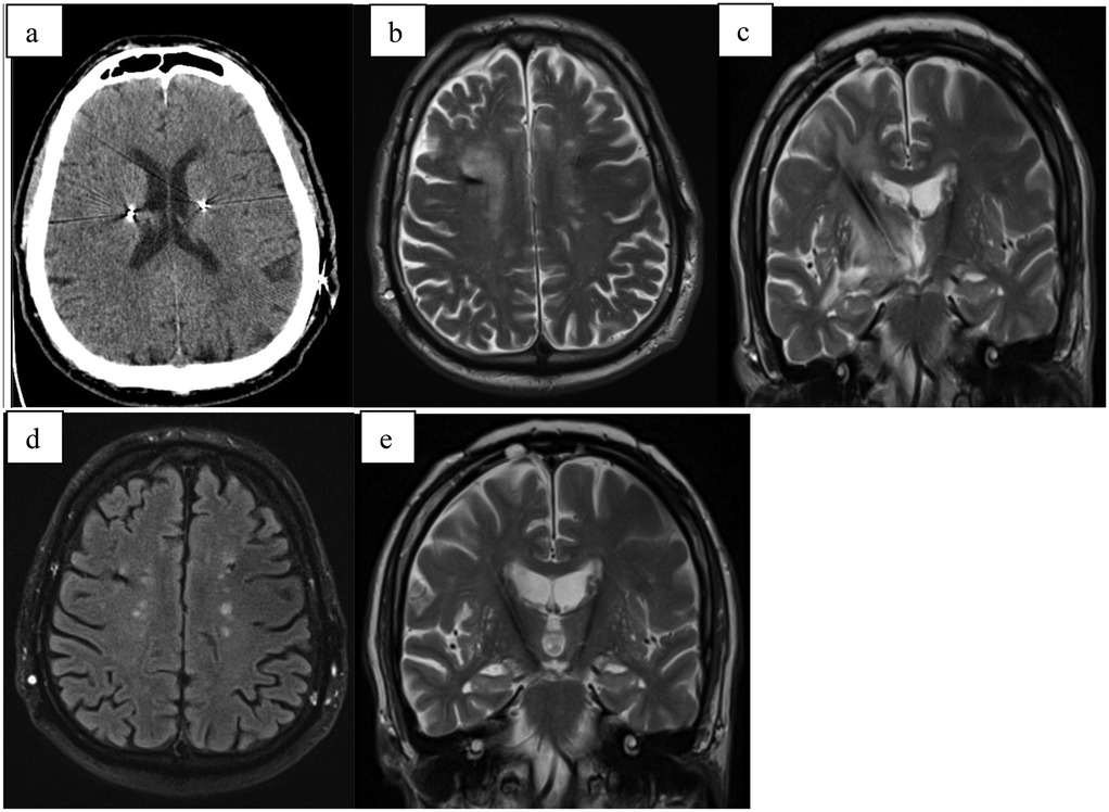 Five medical imaging panels showing brain scans: Panel a is a CT scan showing a cross-sectional view with potential abnormalities. Panels b, c, d, and e are MRI scans in axial and coronal views, highlighting structural details of the brain with visible variations in tissue density.