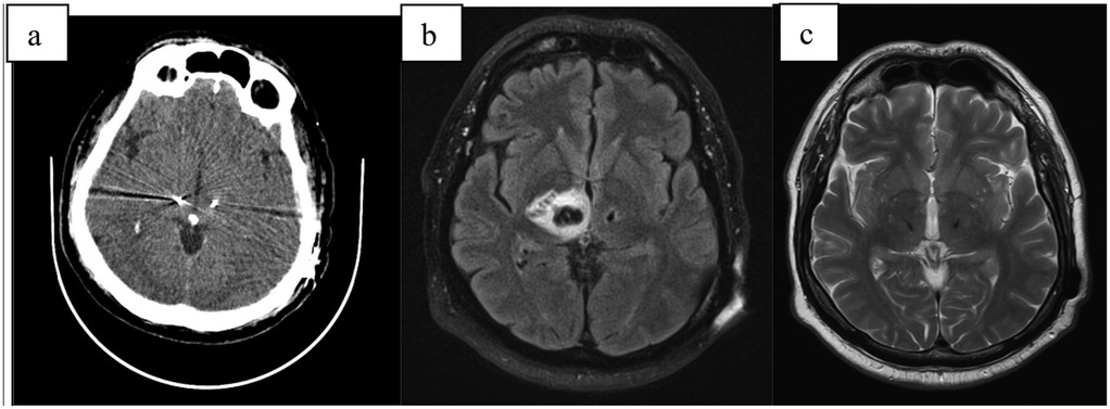 Three panel image of brain scans: (a) Axial CT scan showing a hyperdense area. (b) Axial FLAIR MRI displaying a lesion with surrounding edema. (c) Axial T2-weighted MRI illustrating a similar lesion with clear anatomical details.