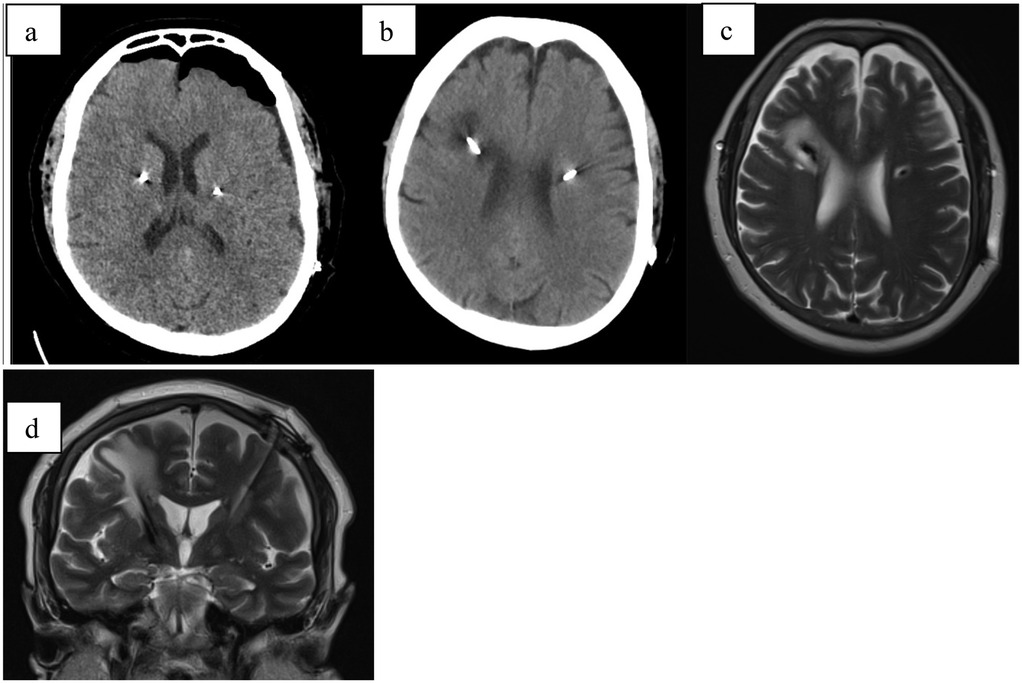 Four medical scanning images labeled a to d. Image a shows a CT scan with visible brain structures. Image b is another CT scan from a different angle. Image c is an MRI scan highlighting brain tissues. Image d is a coronal MRI scan providing a frontal view of the brain.