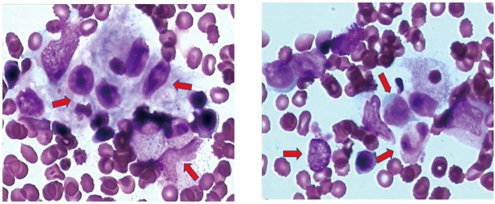 Microscopic images showing stained blood cells, primarily in shades of purple. Red arrows point to specific irregularly shaped cells among the more uniform circular cells. The background is a light blue.