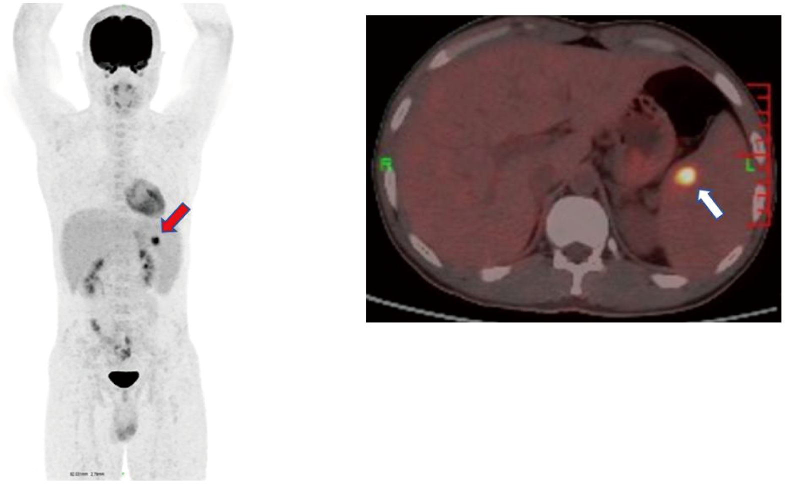 Medical imaging showing two scans. The first is a full-body PET scan with a red arrow pointing to an area on the left side of the abdomen. The second is a cross-sectional CT scan showing a white arrow indicating a bright spot on the right side, likely representing increased metabolic activity.