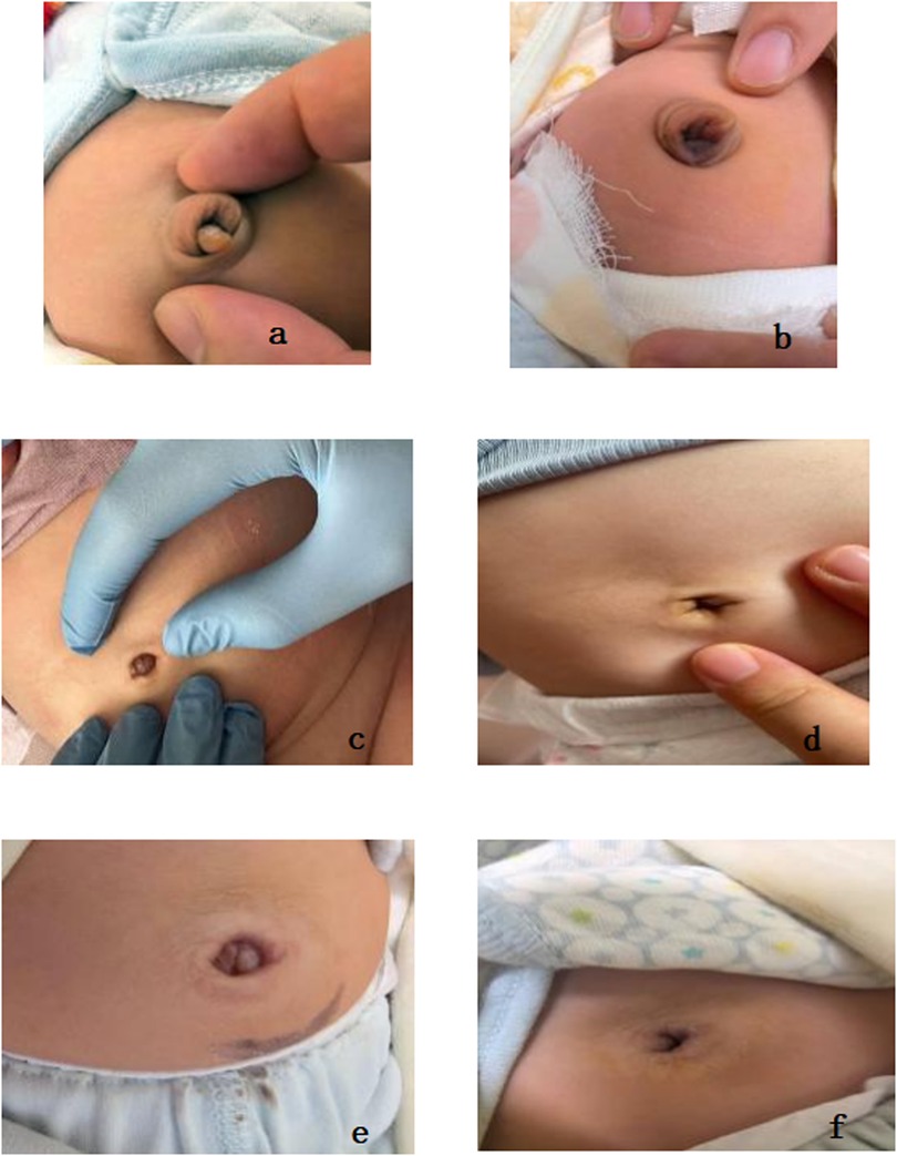 Six images labeled a to f show a baby's navel healing process. Image a shows an umbilical stump held by two fingers. Image b shows the stump with a bandage. Image c has gloved fingers examining the navel. Image d shows a healing navel with fingers pointing. Image e shows further healing. Image f shows a healed navel with no stump.