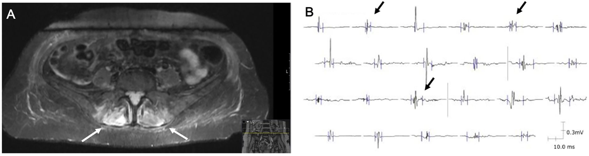 MRI scan of the pelvic region with white arrows indicating areas of interest in panel A. Panel B displays multiple rows of electrical signal graphs with black arrows pointing to specific spikes.