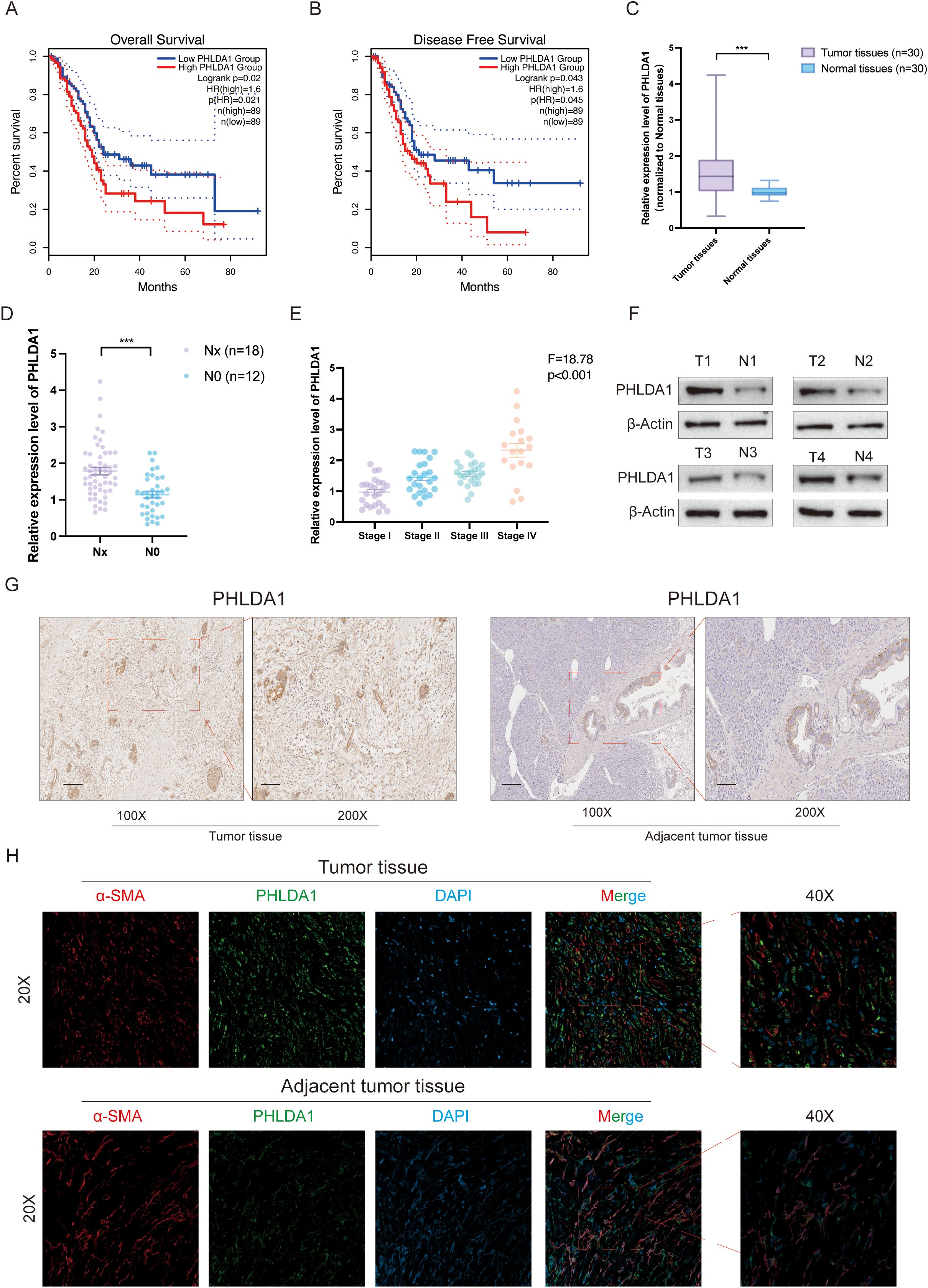 Kaplan-Meier survival plots show overall and disease-free survival for low and high PHLDA1 groups, with statistical significance noted. Box plot compares PHLDA1 expression in tumor and normal tissues, showing increased expression in tumors. Scatter plots indicate PHLDA1 expression across different cancer stages and between Nx and N0 groups. Western blot analysis depicts PHLDA1 levels in tumor and normal tissues. Immunohistochemistry images show PHLDA1 expression in tumor and adjacent tissues at 100x and 200x magnification. Immunofluorescence panels display α-SMA, PHLDA1, DAPI staining, and merged images for tumor and adjacent tissues at 20x and 40x magnification.