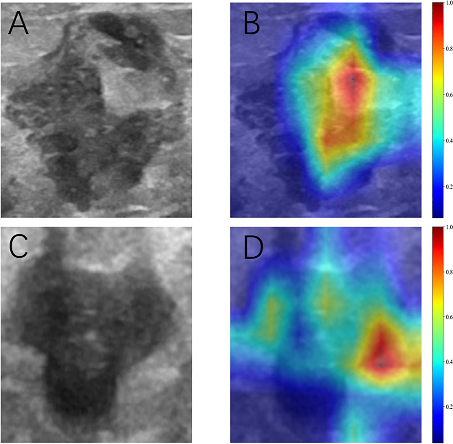 Four panels labeled A to D show ultrasound images and heat maps. Panels A and C display grayscale images of tumor, while B and D present corresponding heap maps. The heat maps variations with a color scale from blue to red. The red areas indicate higher contributing and the blue areas indicate lower contributing for predicting SLN metastasis.