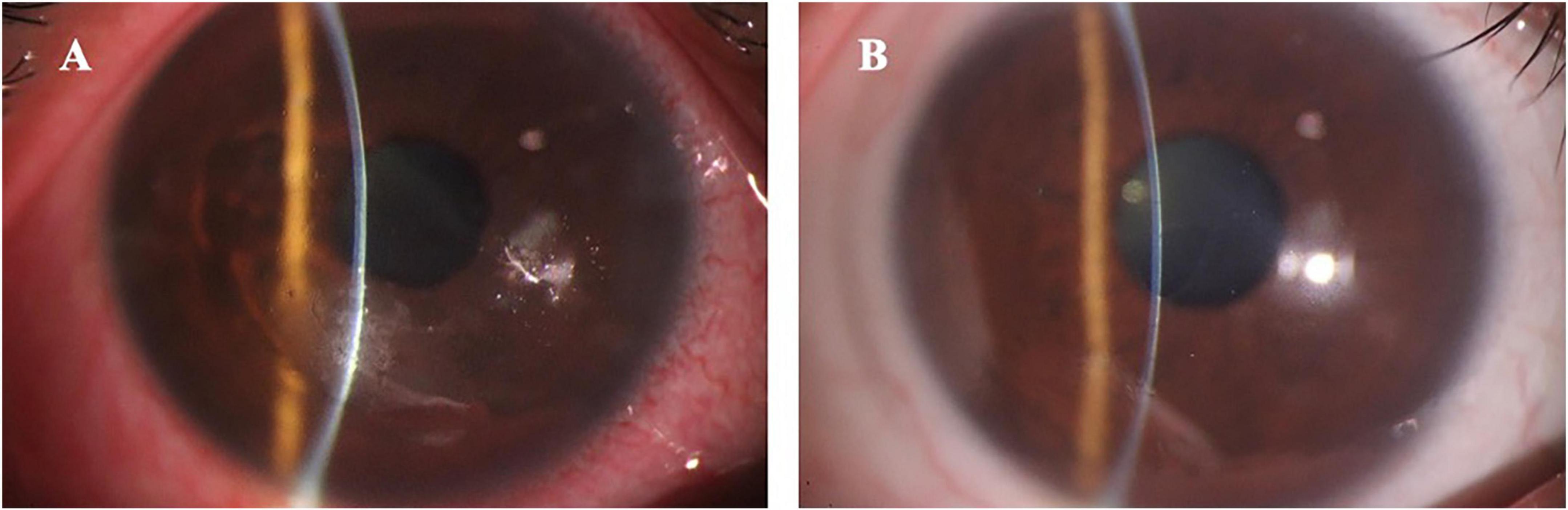 Close-up images of two eyes labeled A and B. Image A shows an eye with conjunctival congestion, corneal epithelial edema turbidity, epithelial loose and erosion, indicating possible disease or damage. Image B shows a healthy eye with a clear cornea, devoid of any abnormalities.