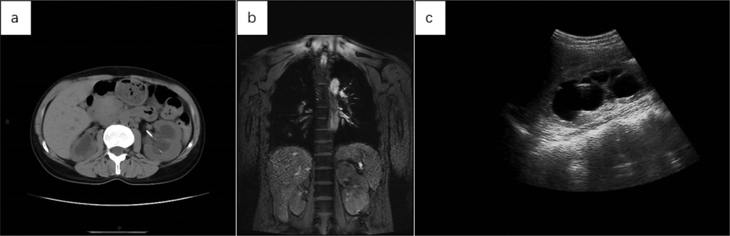 Composite medical imaging showing: (a) a CT scan displaying an axial view of the abdomen, highlighting internal organs; (b) an MRI scan displaying a coronal view of the upper abdomen with detailed organ structures; (c) an ultrasound image showing an abdominal section with dark cystic areas.