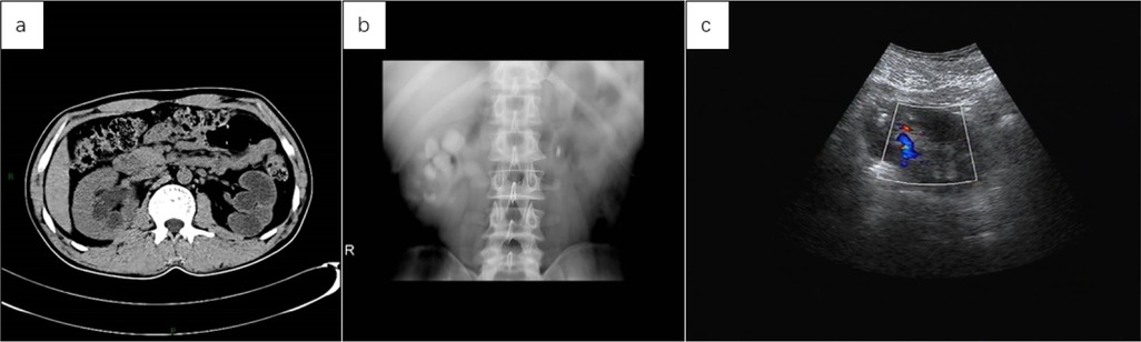Three medical imaging scans labeled a, b, and c. Image a shows a CT scan of the abdomen, highlighting various internal structures. Image b displays an X-ray of the lower spine. Image c is an ultrasound with color Doppler, indicating blood flow in a specified area.