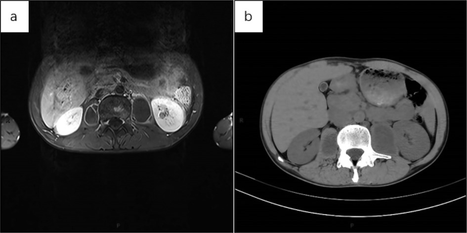 MRI and CT scan images showcasing axial views of the abdomen. Image (a) is an MRI showing various organs and tissues with different signal intensities. Image (b) is a CT scan displaying the abdominal cross-section with varying densities. Both images highlight anatomical structures around the lumbar vertebrae.