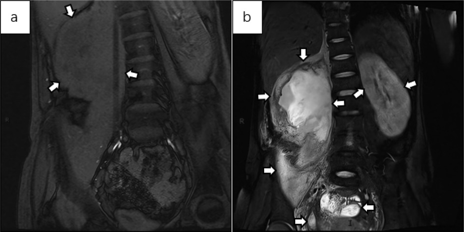 MRI scans show two coronal sections labeled a and b. Section a highlights an abdominal area with arrows pointing to specific features near the spine and surrounding tissues. Section b shows a large, bright mass near the spine, with arrows indicating its locations relative to nearby structures.