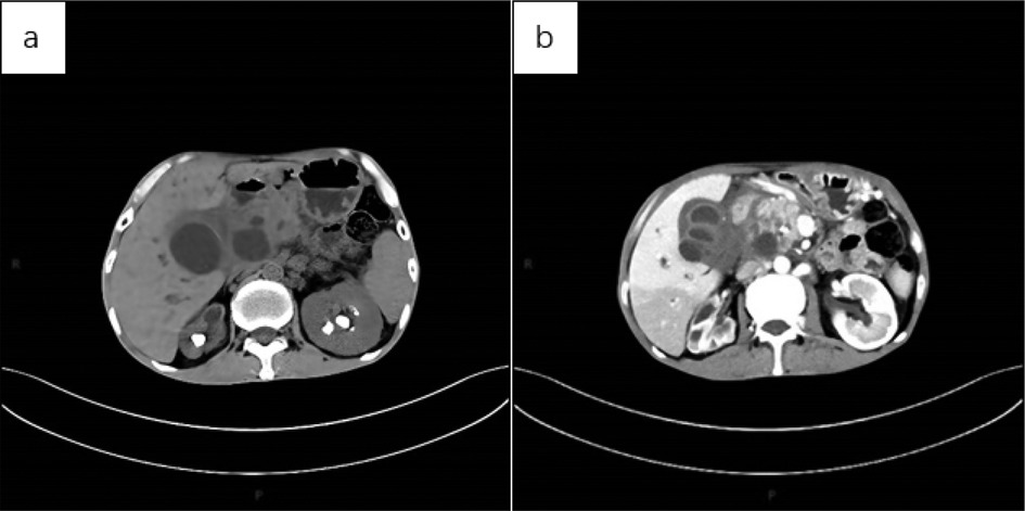 Two CT scan images labeled (a) and (b) display cross-sectional views of the abdomen. Image (a) shows various abdominal structures including organs and tissues. Image (b) presents a similar view with slight variations in contrast and organ appearance. Both images include vertebrae, kidneys, and surrounding tissues.