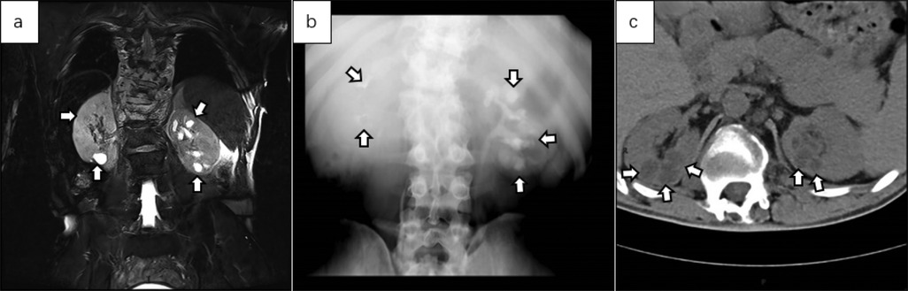 Panel a shows an MRI image of the abdominal region with arrows indicating lesions on both kidneys. Panel b displays an X-ray of the abdomen with arrows highlighting abnormalities in the upper region. Panel c illustrates a CT scan of the same area with arrows pointing to particular spots along the spine and kidneys.