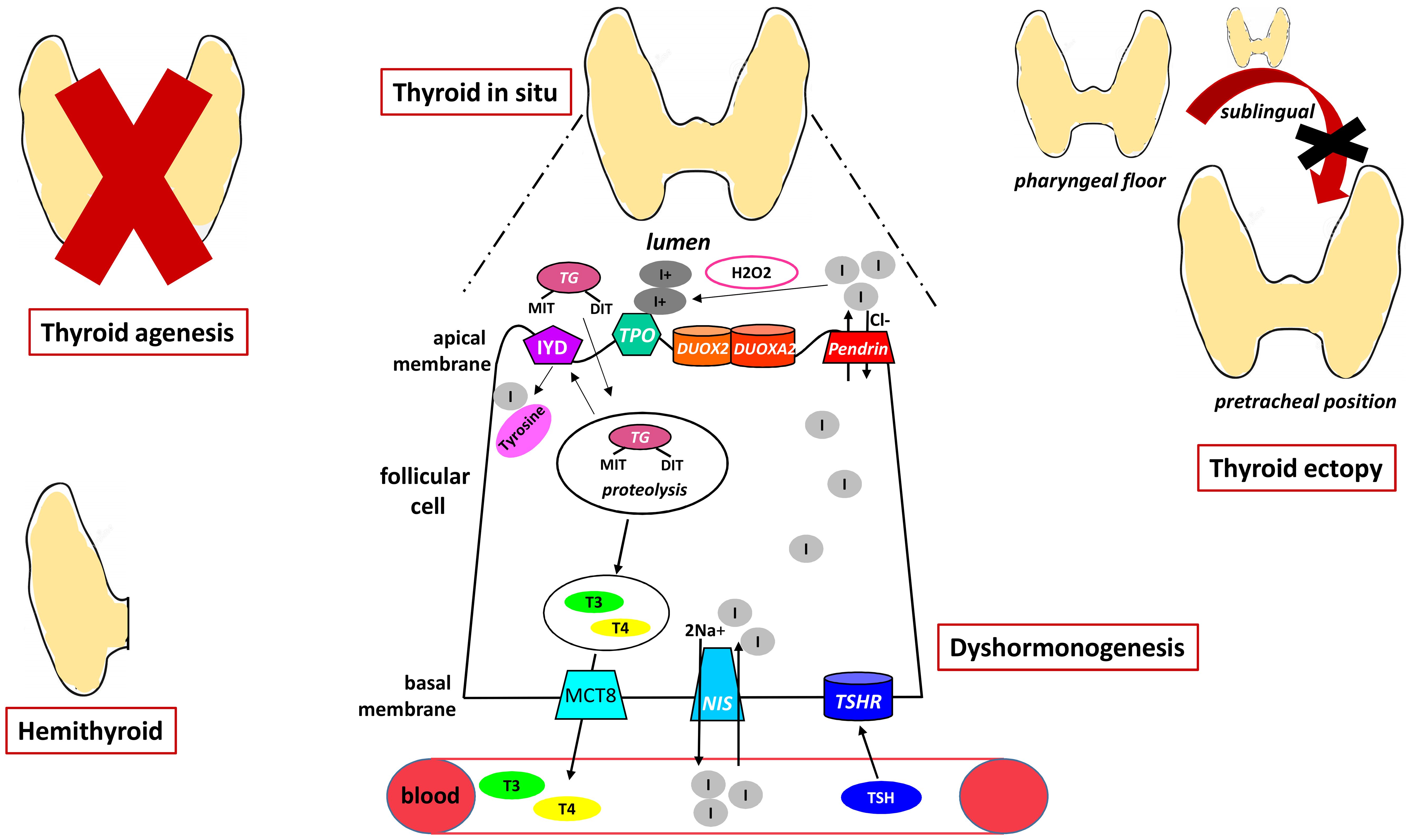 Diagram illustrating various thyroid conditions and processes. On the left is thyroid agenesis with a crossed-out thyroid, and hemithyroid with a partial thyroid. In the center is a detailed process of thyroid hormone synthesis, including components like Iodine, Tyrosine, and enzymes such as TPO and DUOX2. The blood connection shows T3, T4, and TSH hormones. On the right, thyroid ectopy is displayed, showing misplacement from the pharyngeal floor to the pretracheal position. Labels highlight different conditions and components.